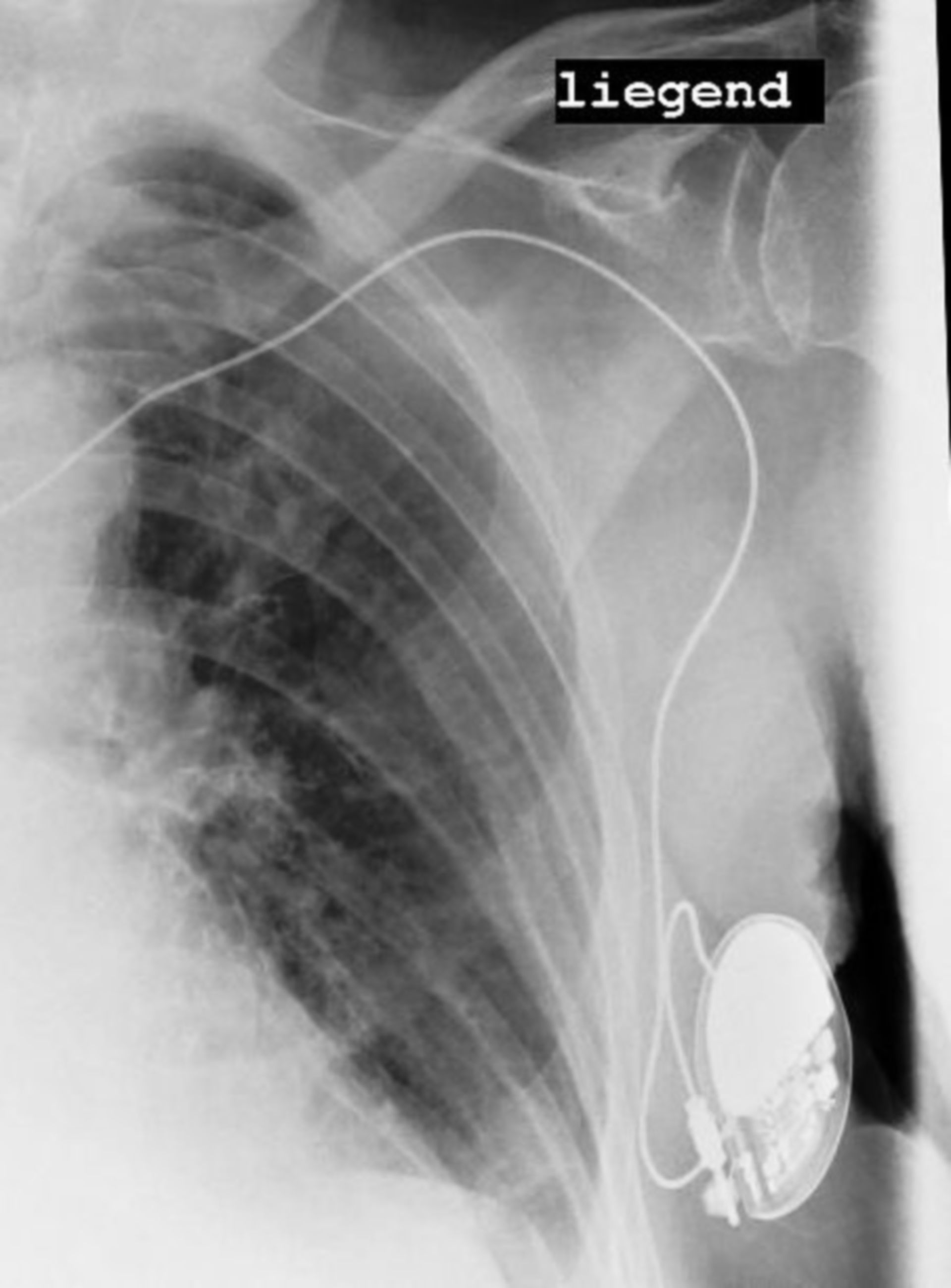 Dislocazione del pacemaker