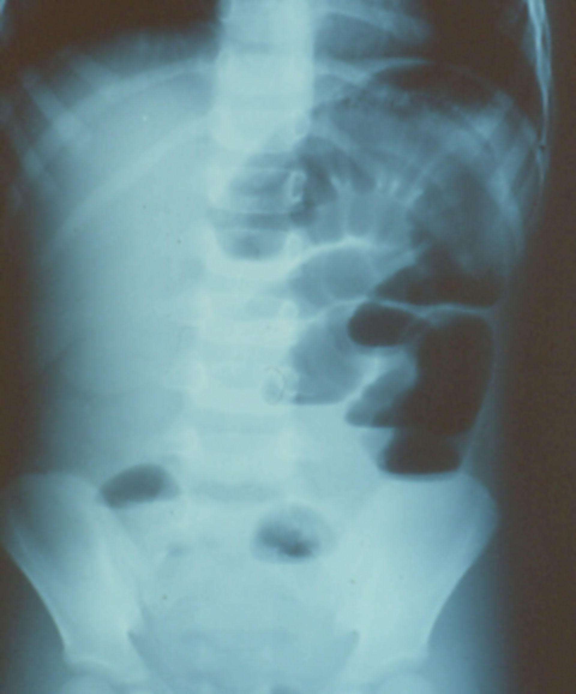 Ileus, caused by a bezoar