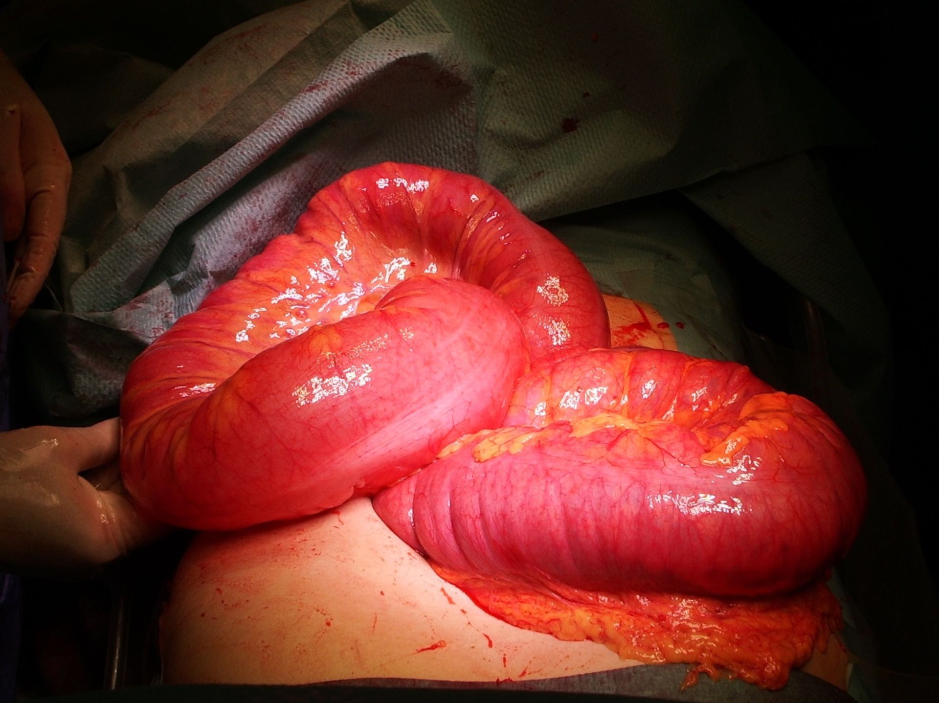 Ileus of the large intestines in enlarged sigmoid