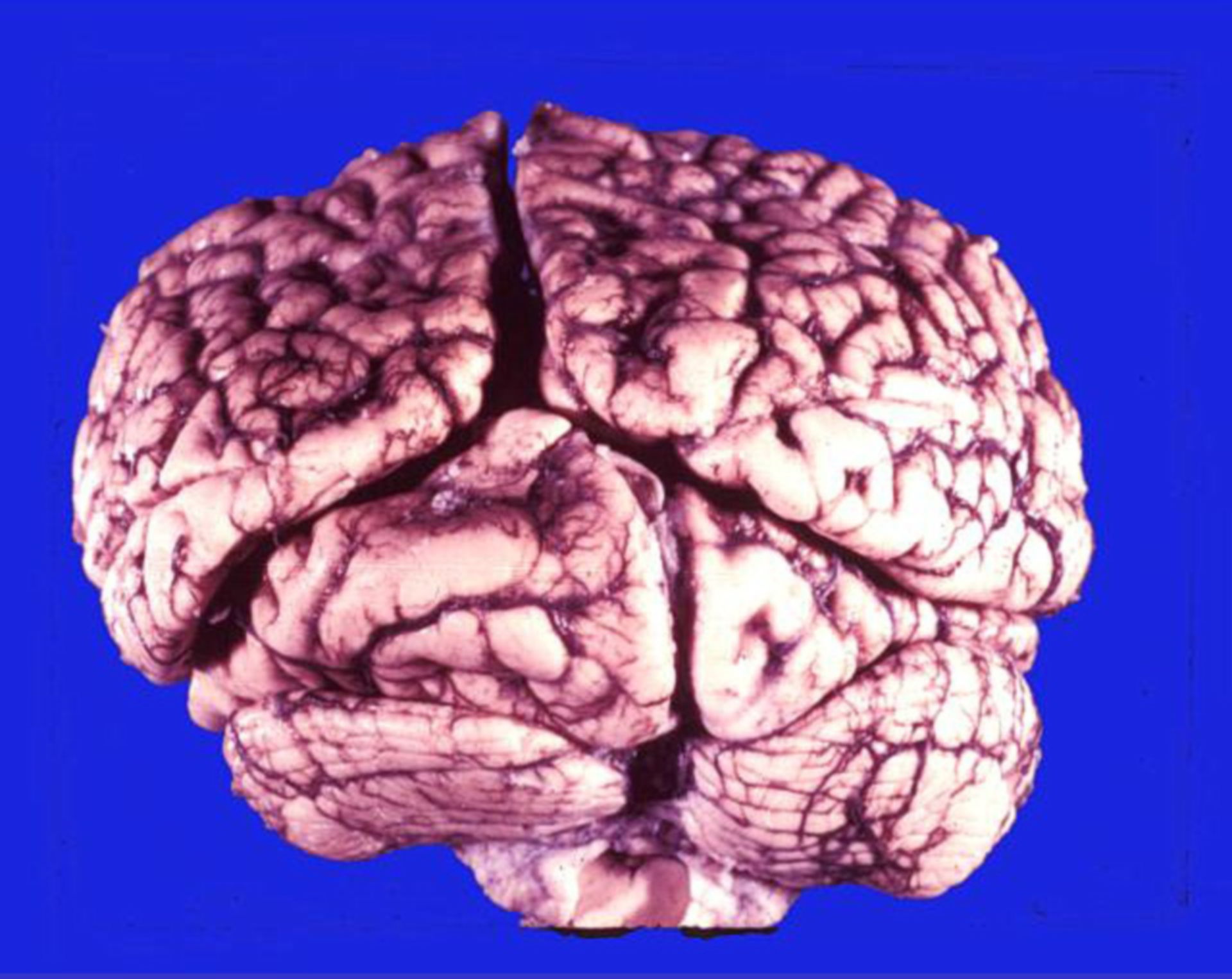 Occipital lobe below the tentorium