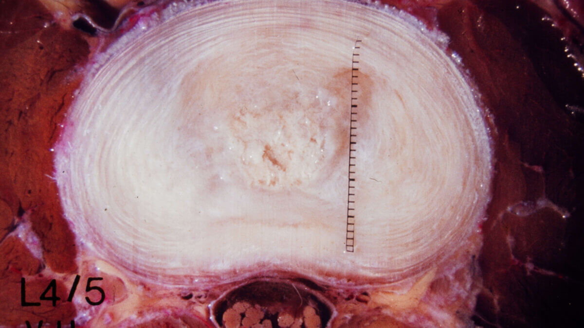 Bandscheibe – Nucleus pulposus