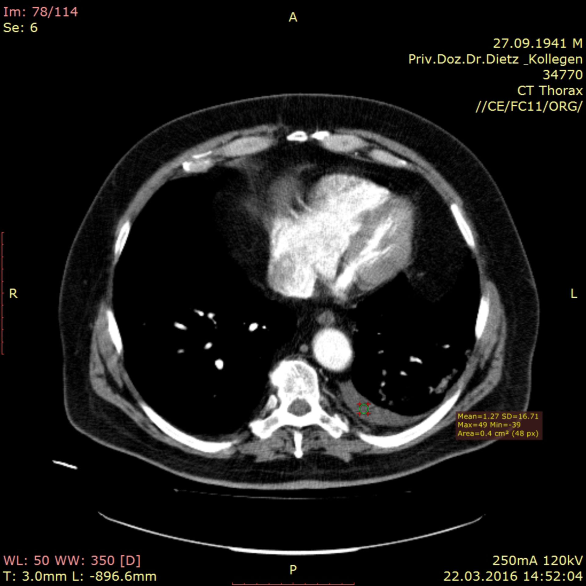 ct_5: CT der Lunge