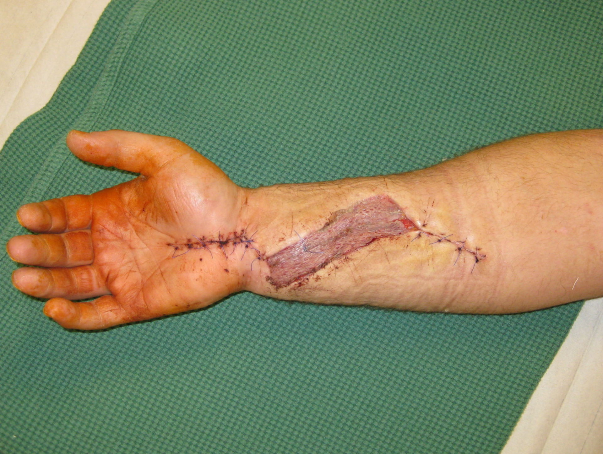 Acute ischemia of the fingers after unintentional intra-arterial injection of flunitrazepam 3 weeks after surgery