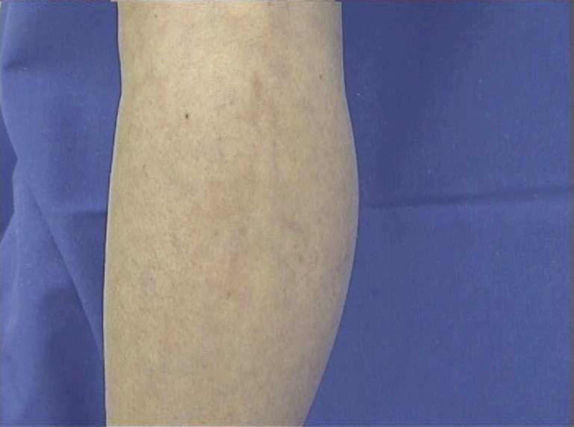 Post-therapeutic spider veins