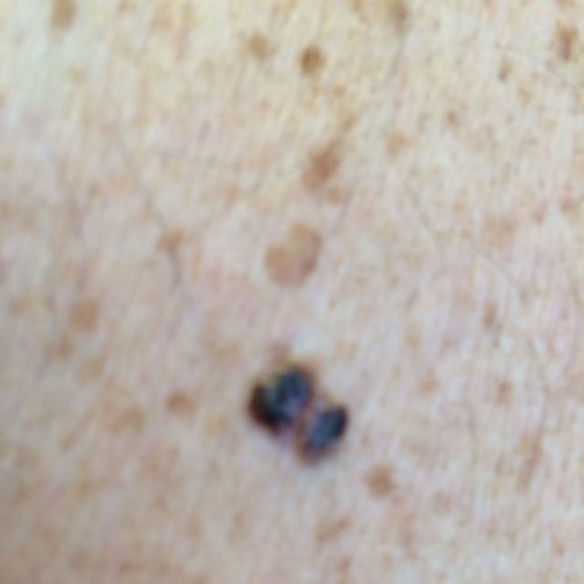 Seborrhoeic keratosis, close-up with iPhone 5s without flash