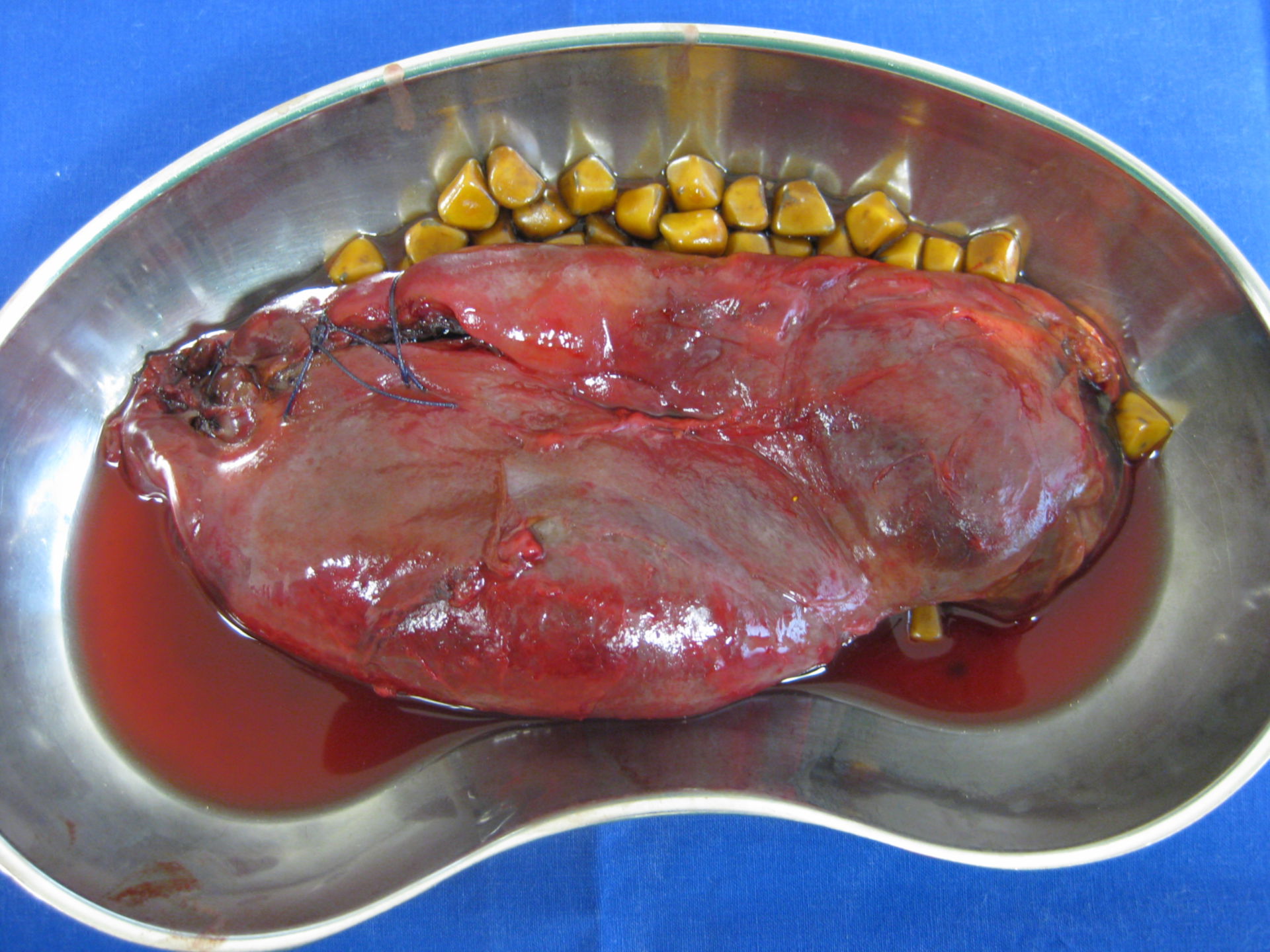 Acute cholecystitis - gall bladder the size of a stomach