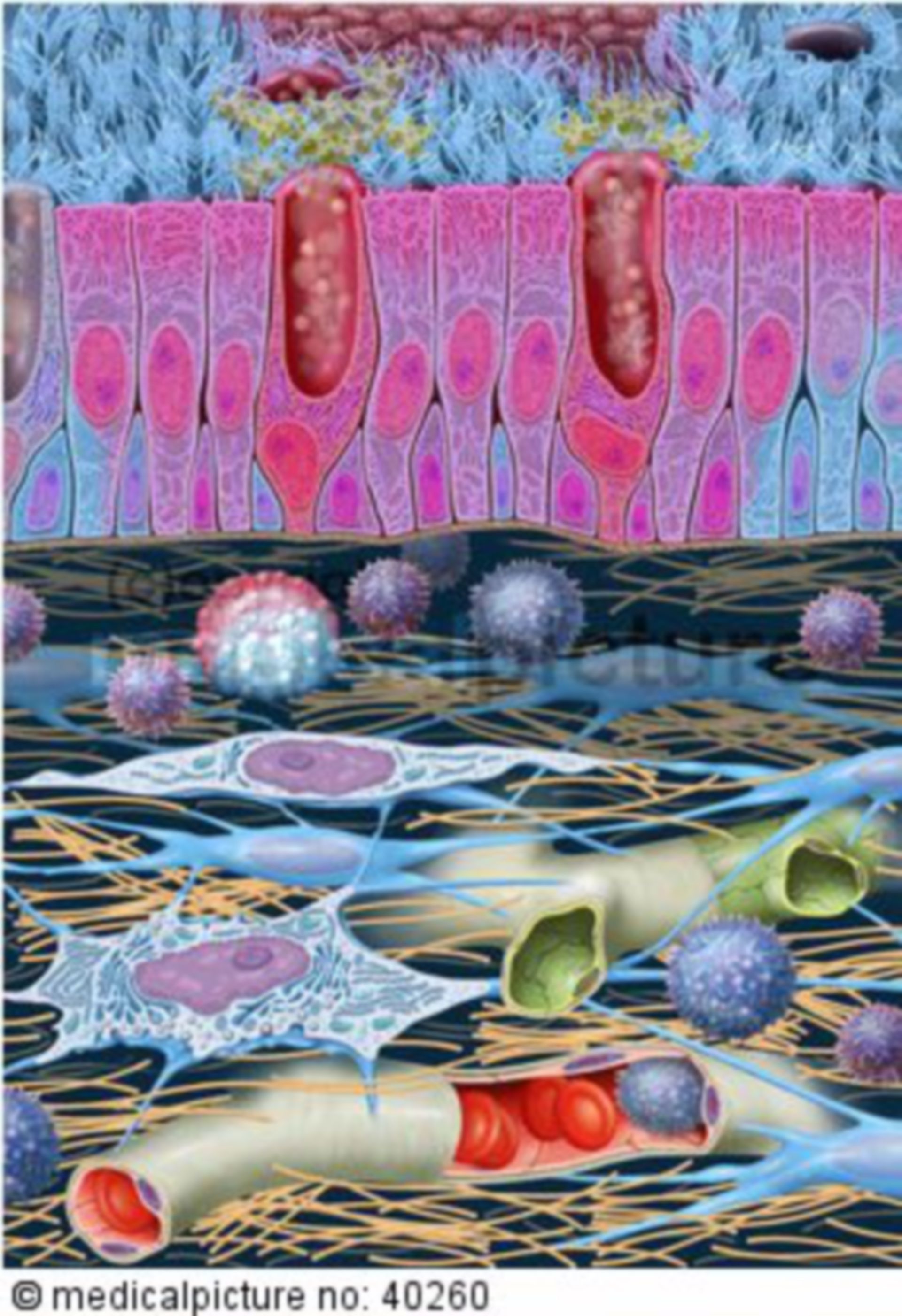  Schleimproduzierende Epithelzellen bei bestehender Bronchitis 

