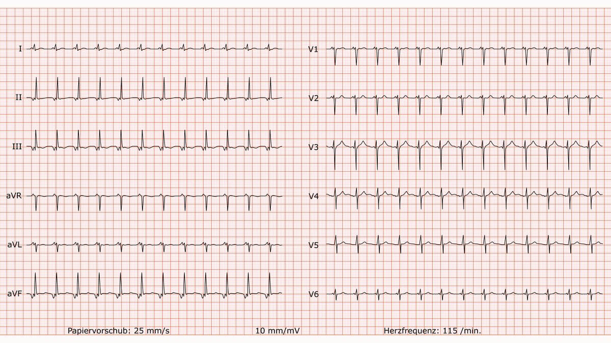 12-Kanal-EKG bei junktionaler ektoper Tachykardie