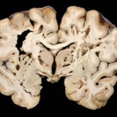 Subarachnoidalblutung DocCheck Flexikon