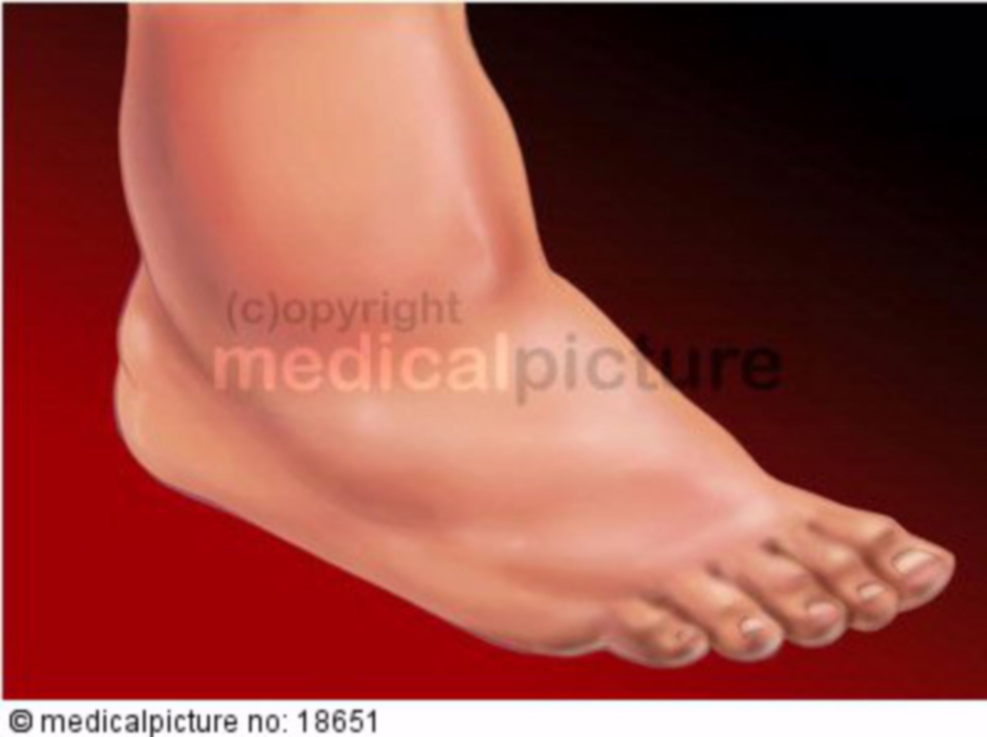 Diabetische Fußsyndrom Charcot-Fuß