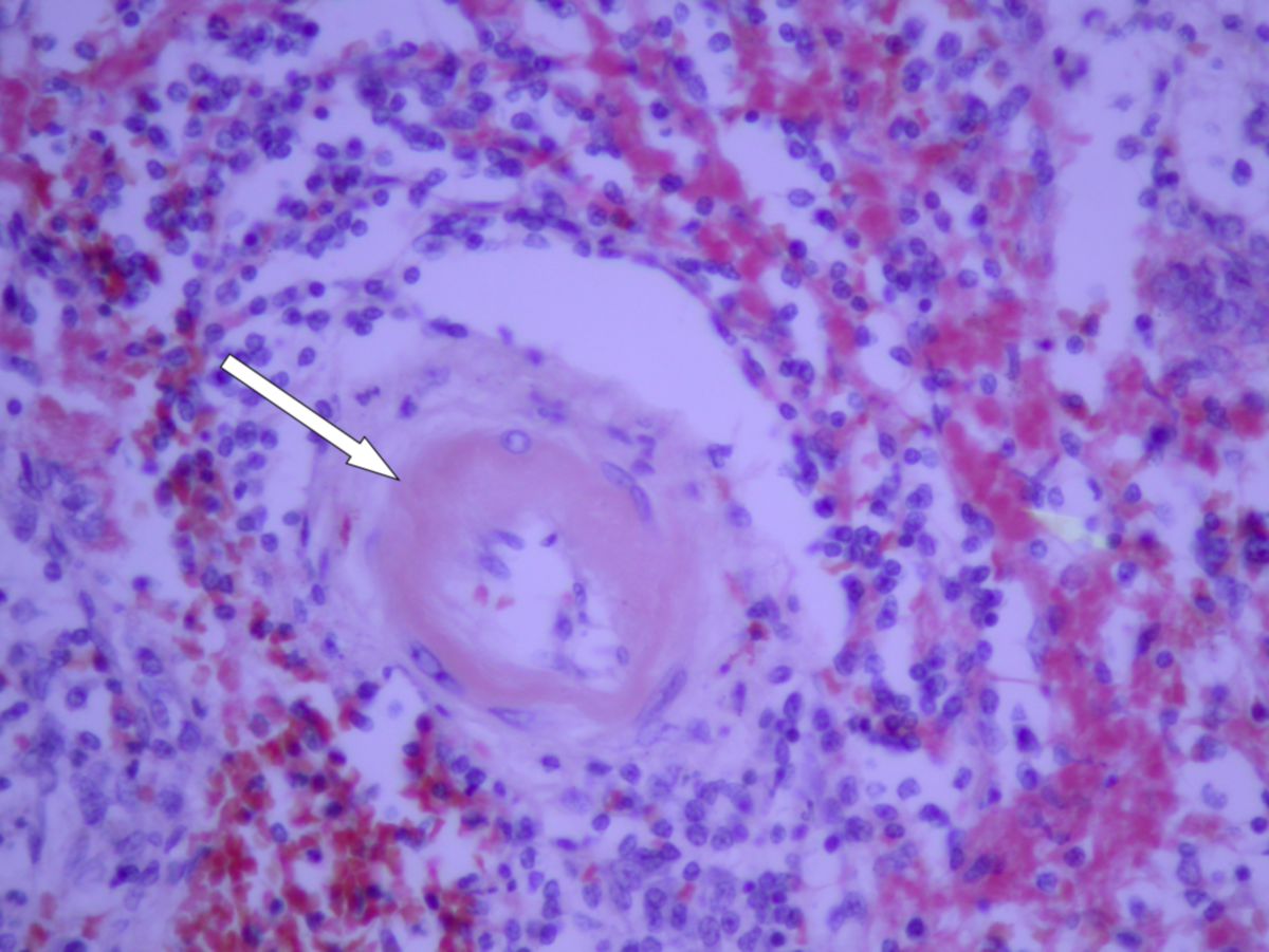 Peri-vaskuläres Amyloid A (Histologie)