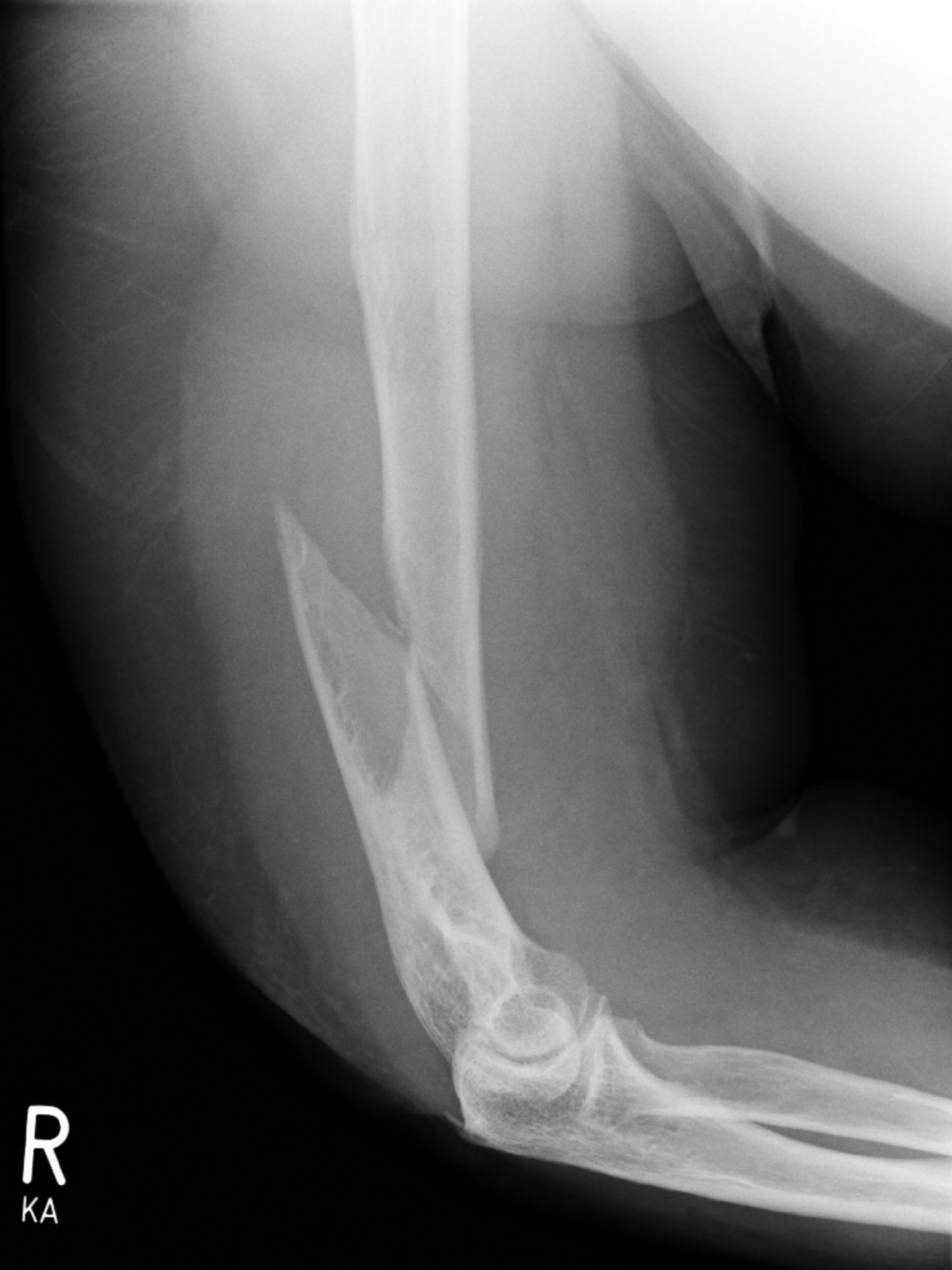 Supracondylar humerus fracture - lateral view