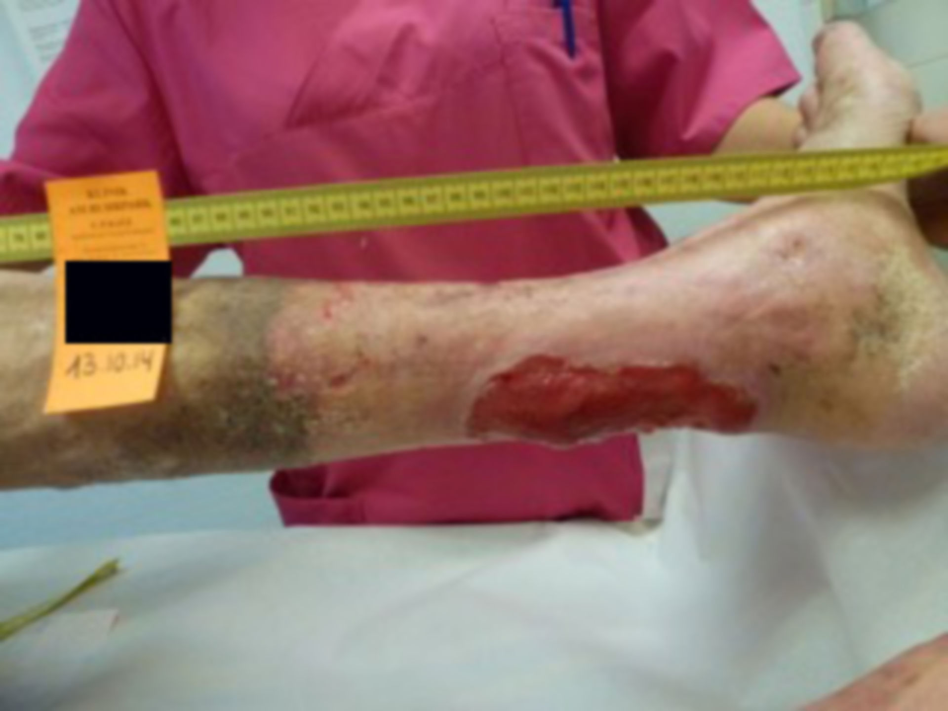 Ulcer of the lower leg - open for 40 years (33)