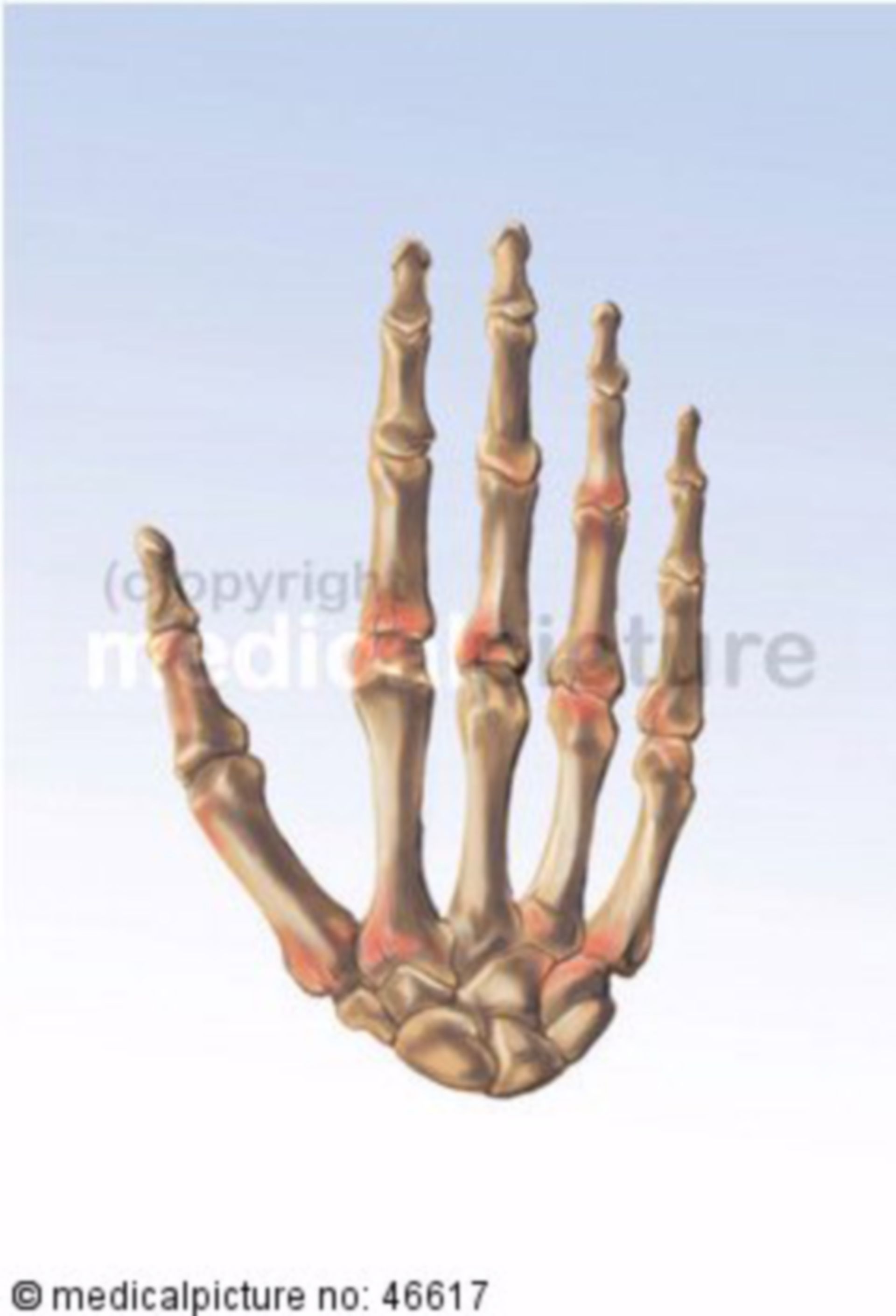  Handskelett mit Arthritis 
