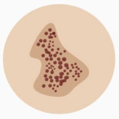 Naevus spilus DocCheck Flexikon