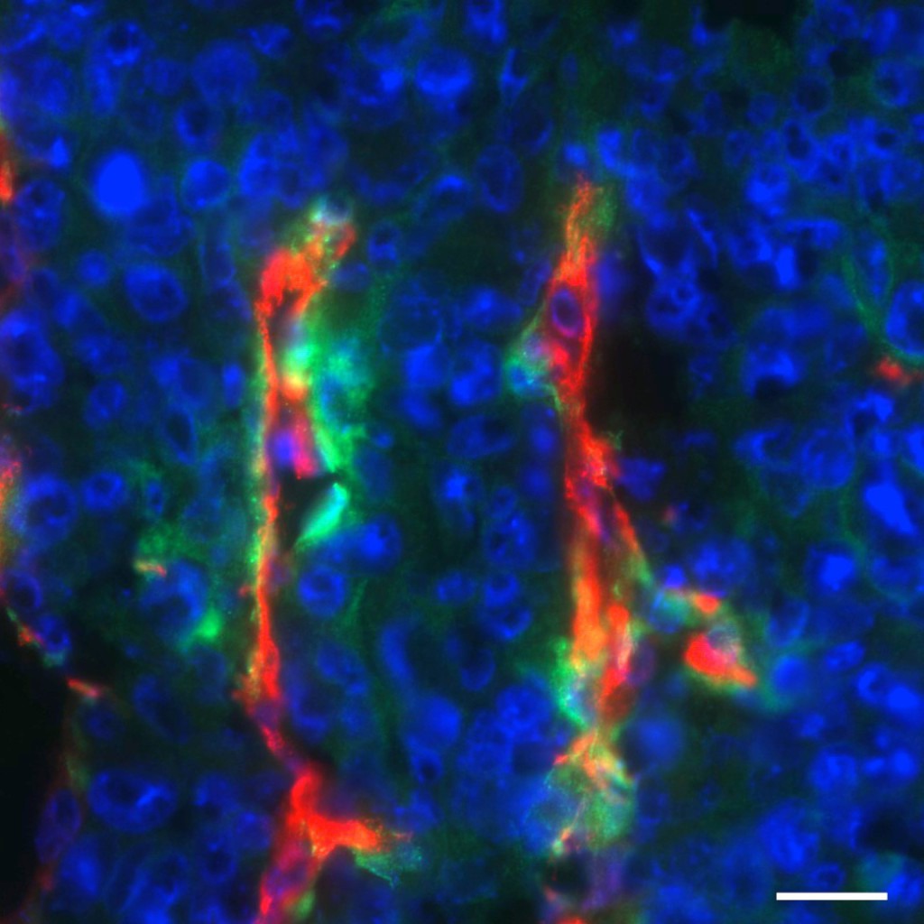 Brustkrebszellen in der Maus: Die Blutgefäße (rot) sind von Perizyten bedeckt, die Endosialin (grün) produzieren.