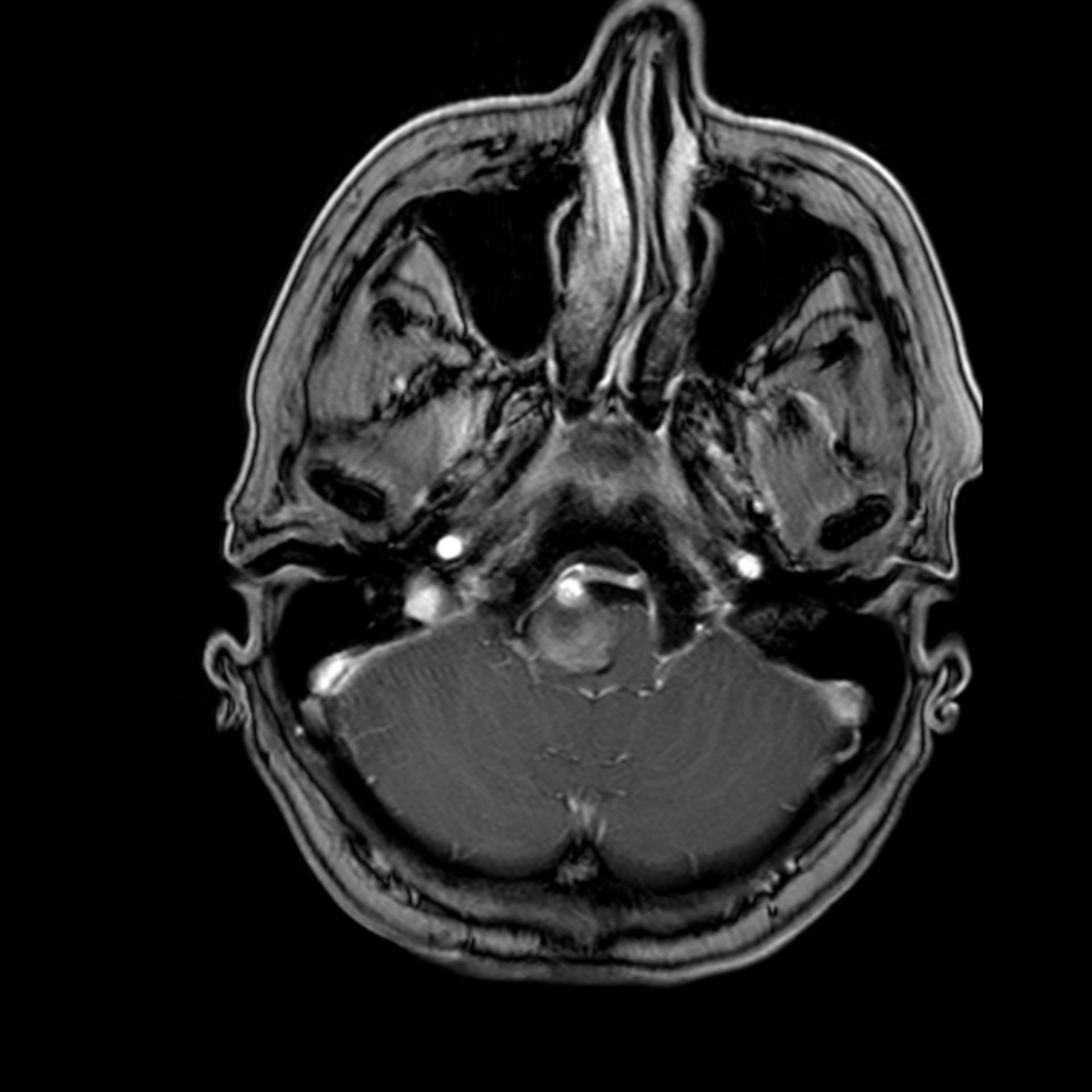 Riesenaneurysma der A. vertebralis (t1_km_tra00001)