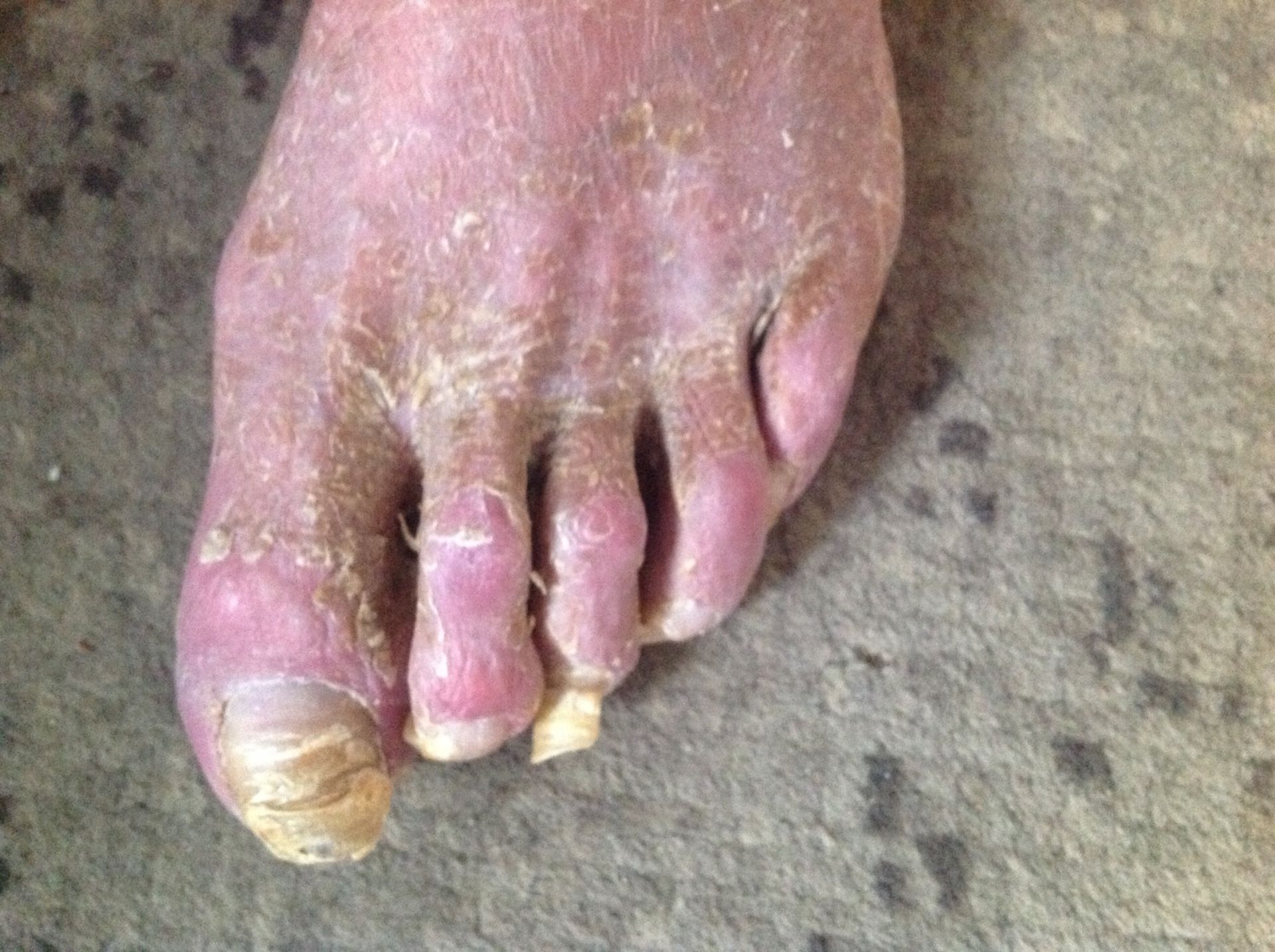 Parkinson-Patient ohne Fußpflege (1)