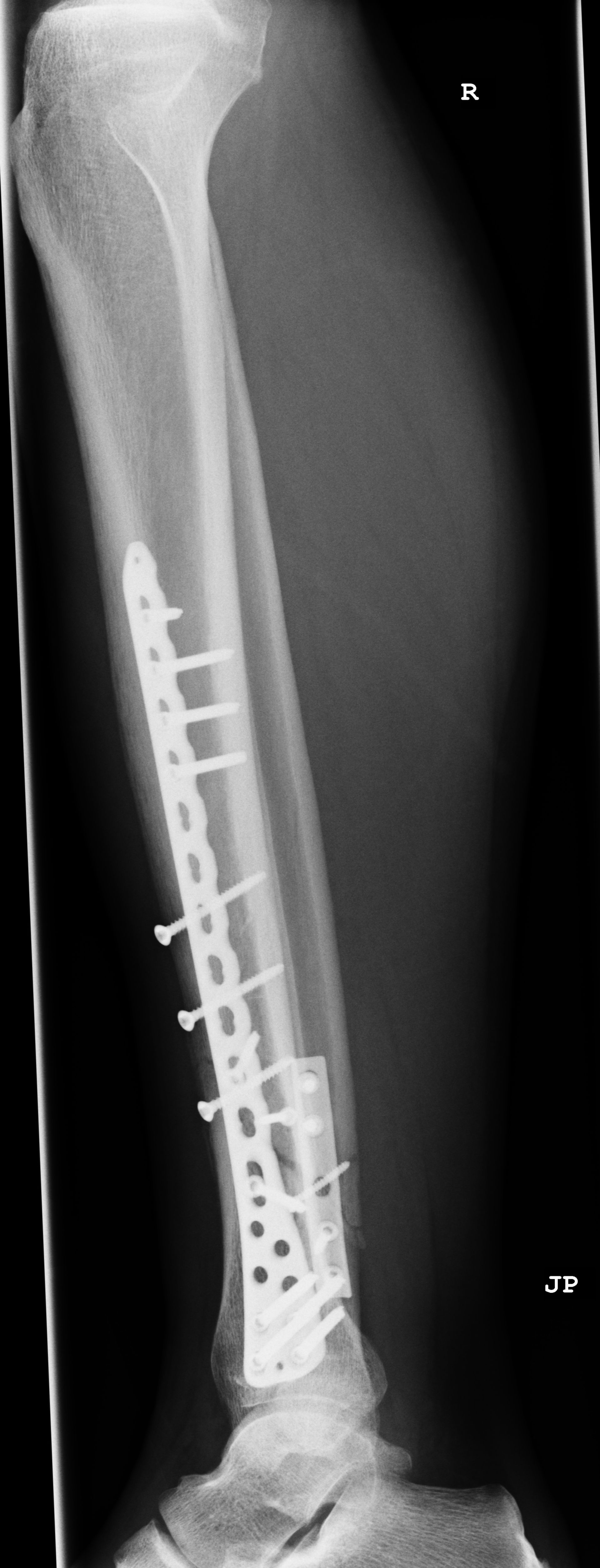 Frattura della gamba-osteosintesi