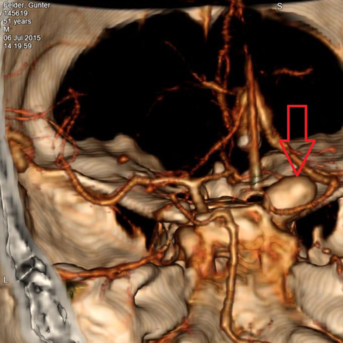 aneurysma-aci1_md.jpg