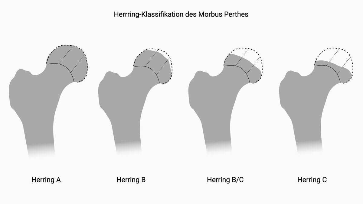 Herring-Klassifikation