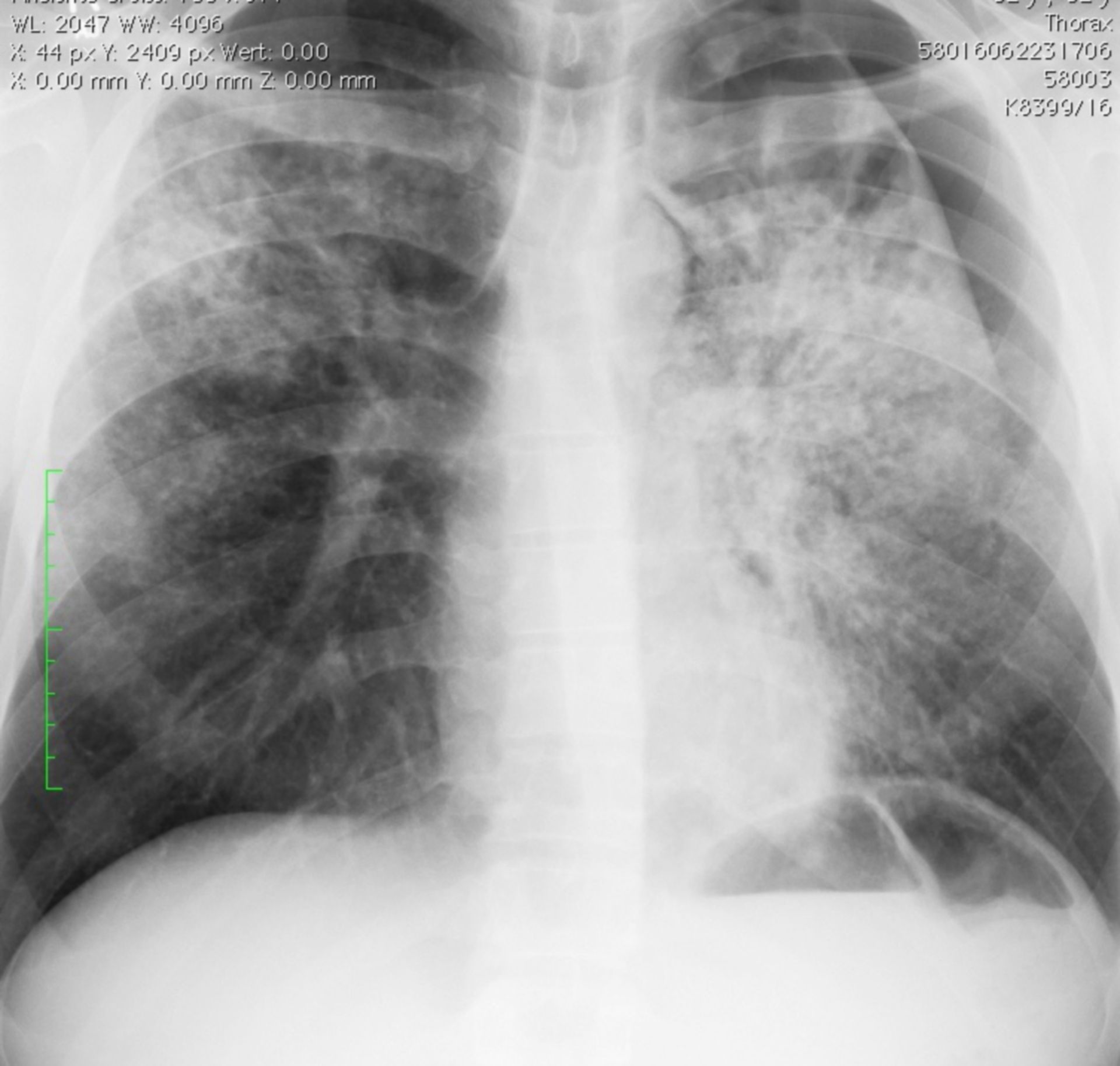 Pneumothorax links