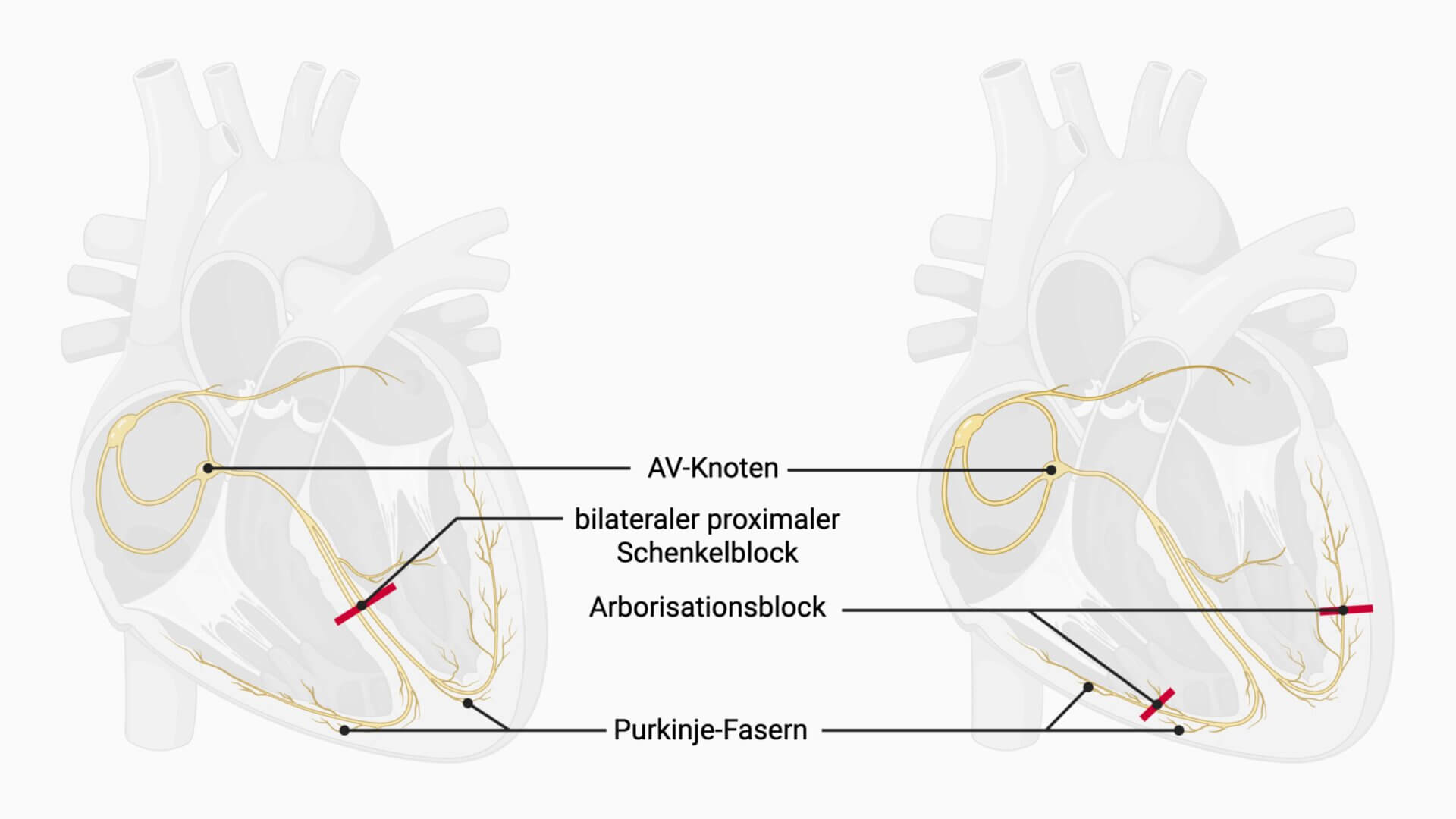 bilateraler Schenkelblock vs Arborisationsblock
