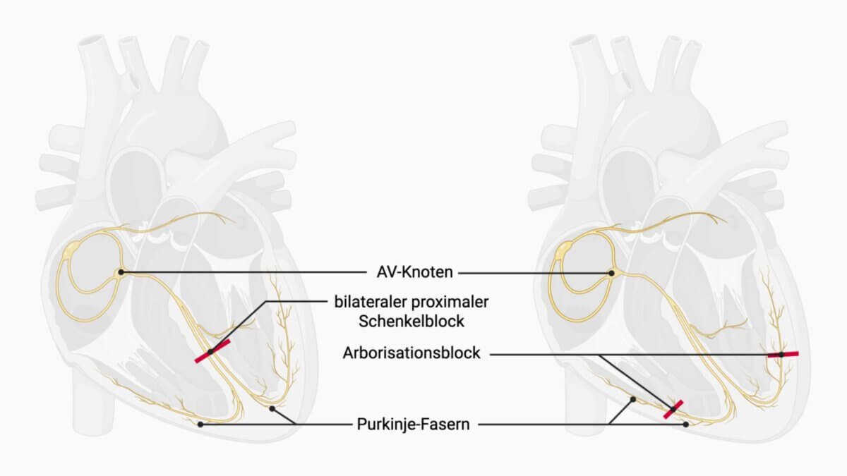bilateraler Schenkelblock vs Arborisationsblock
