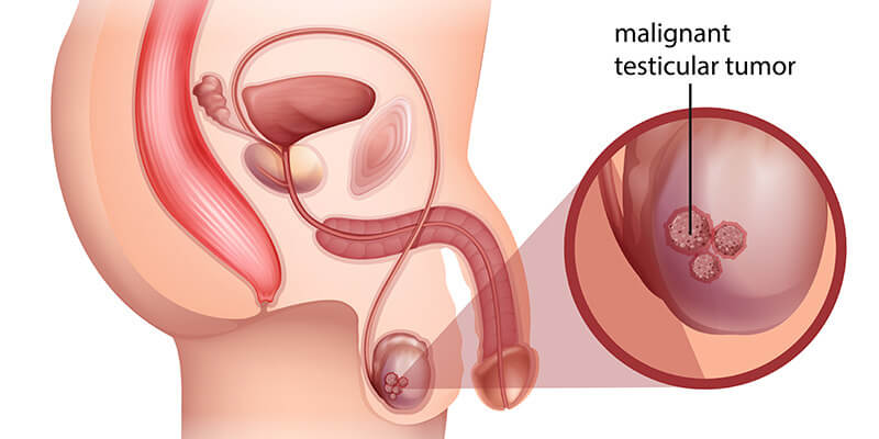 Testicular Cancer Doccheck