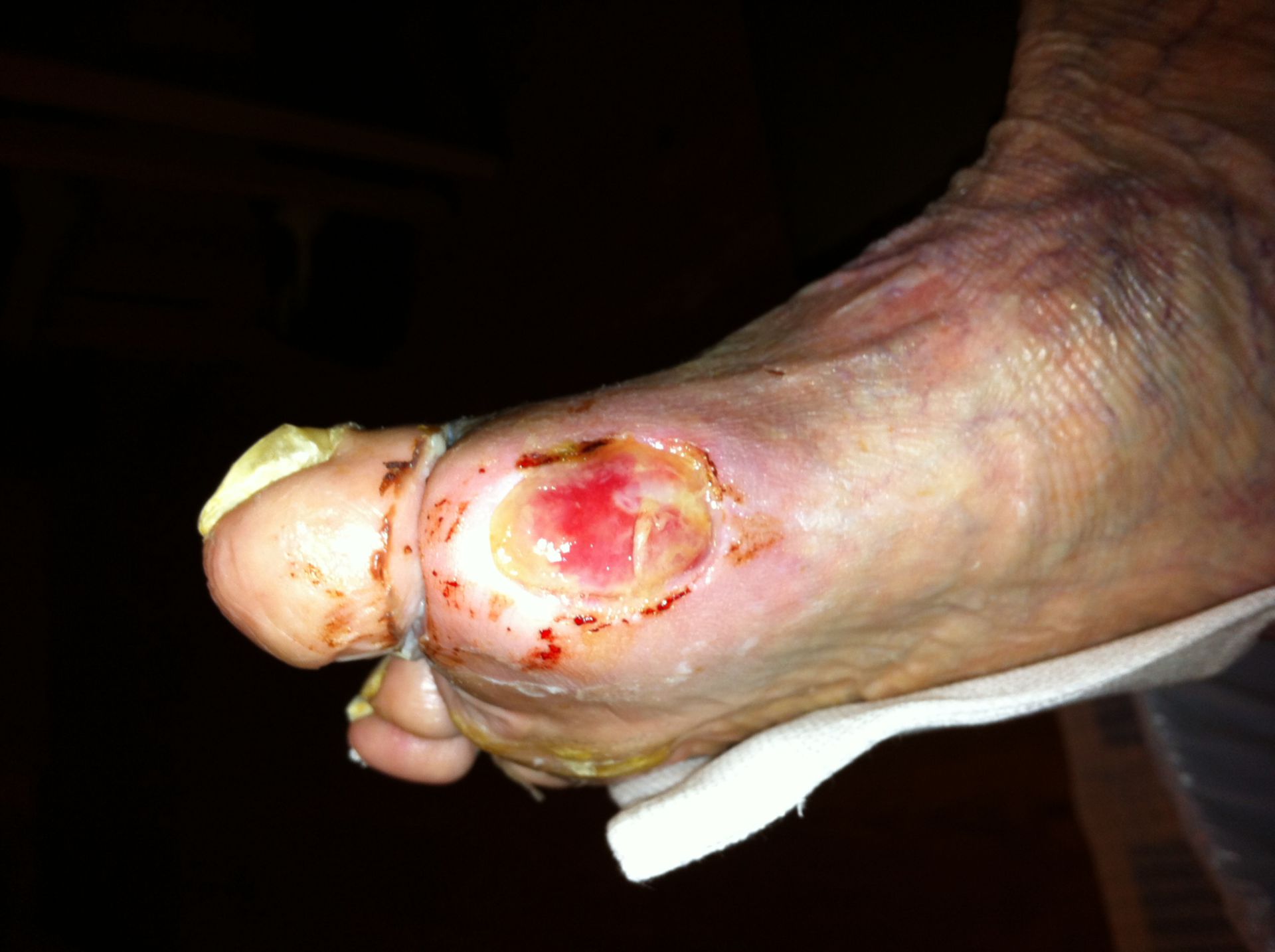 Diabetic foot syndrom