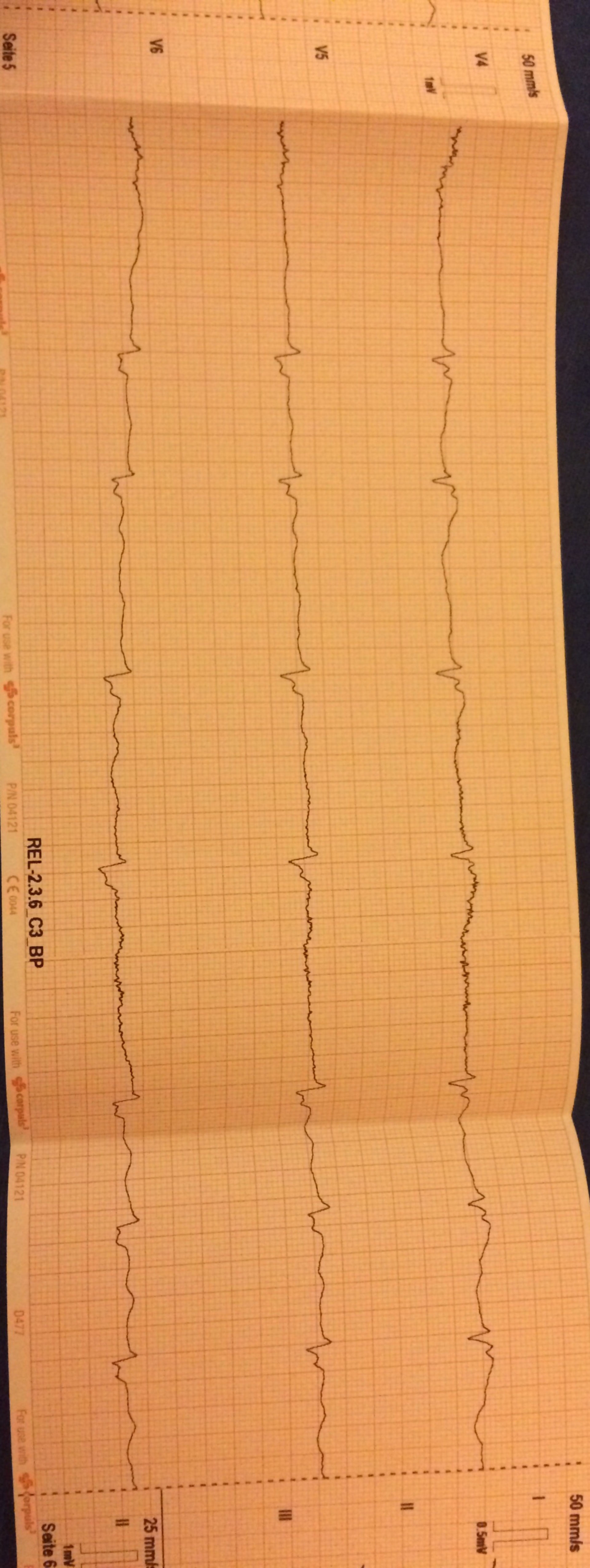 EKG Aufnahme einer 90-jährigen Patientin