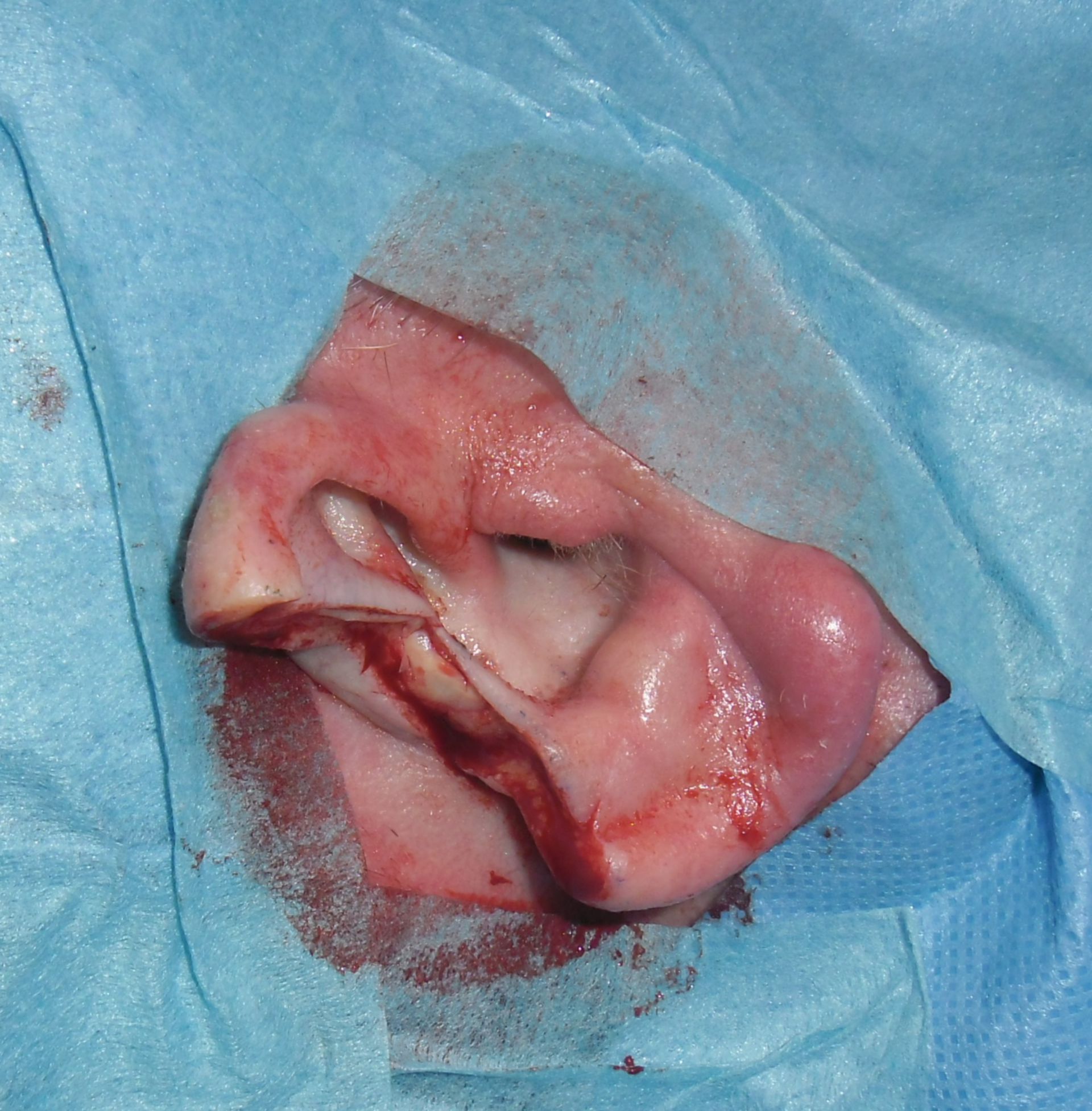 Carcinoma celular escamosa de la concha auricular