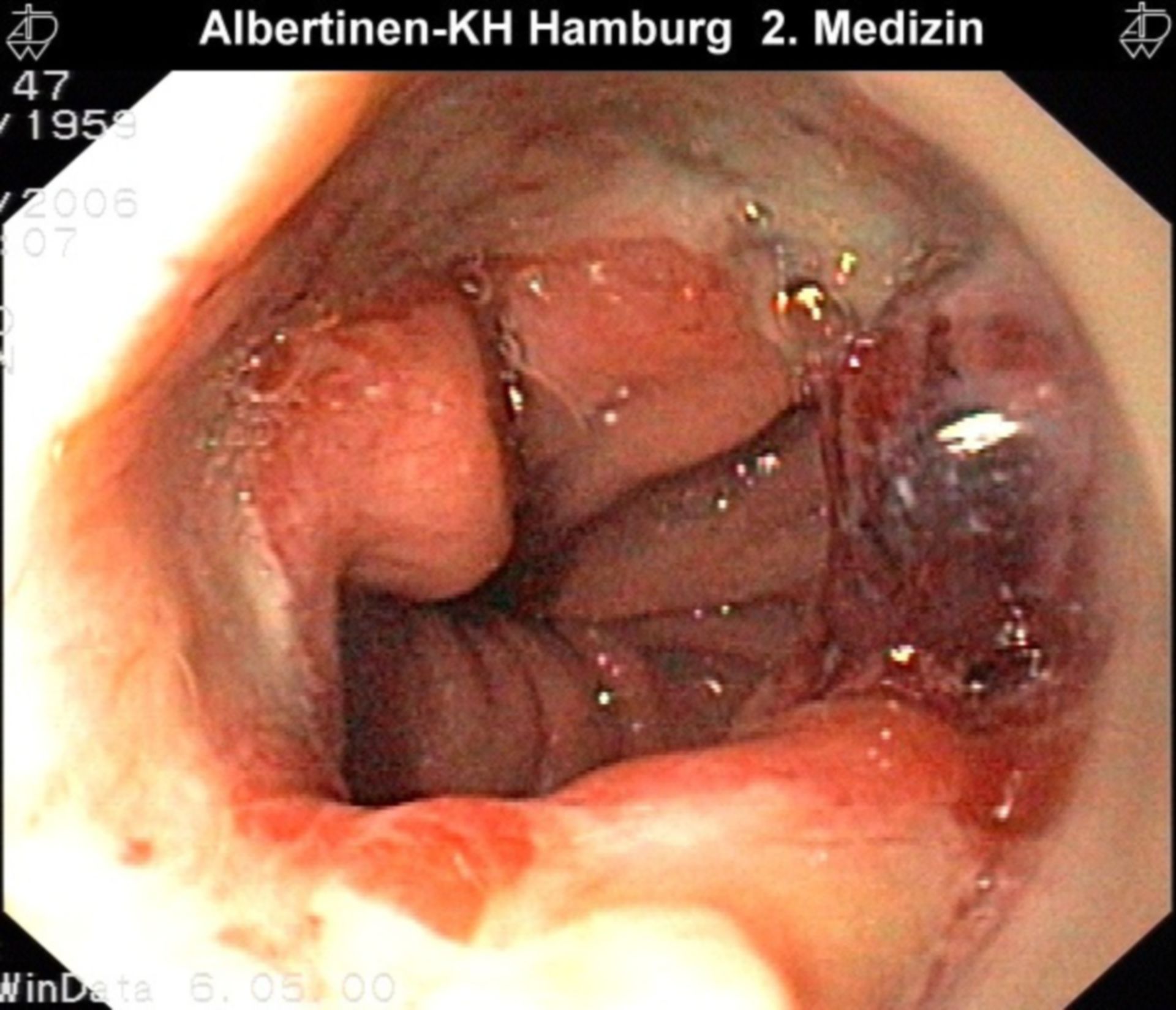 Ulcer in esophageal and stomach junction