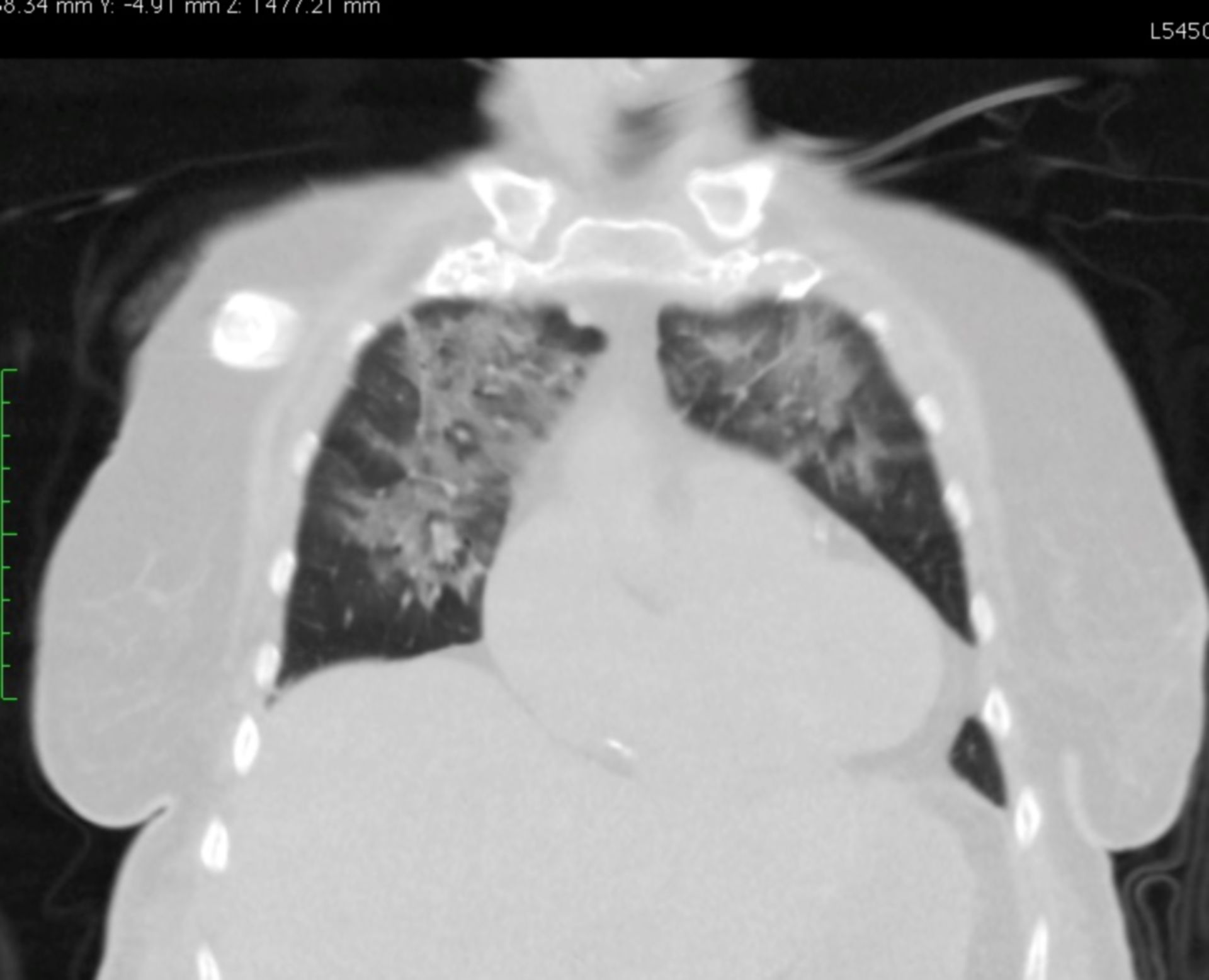 CT des Thorax in frontaler Ebene mit Kardiomegalie (1/3)
