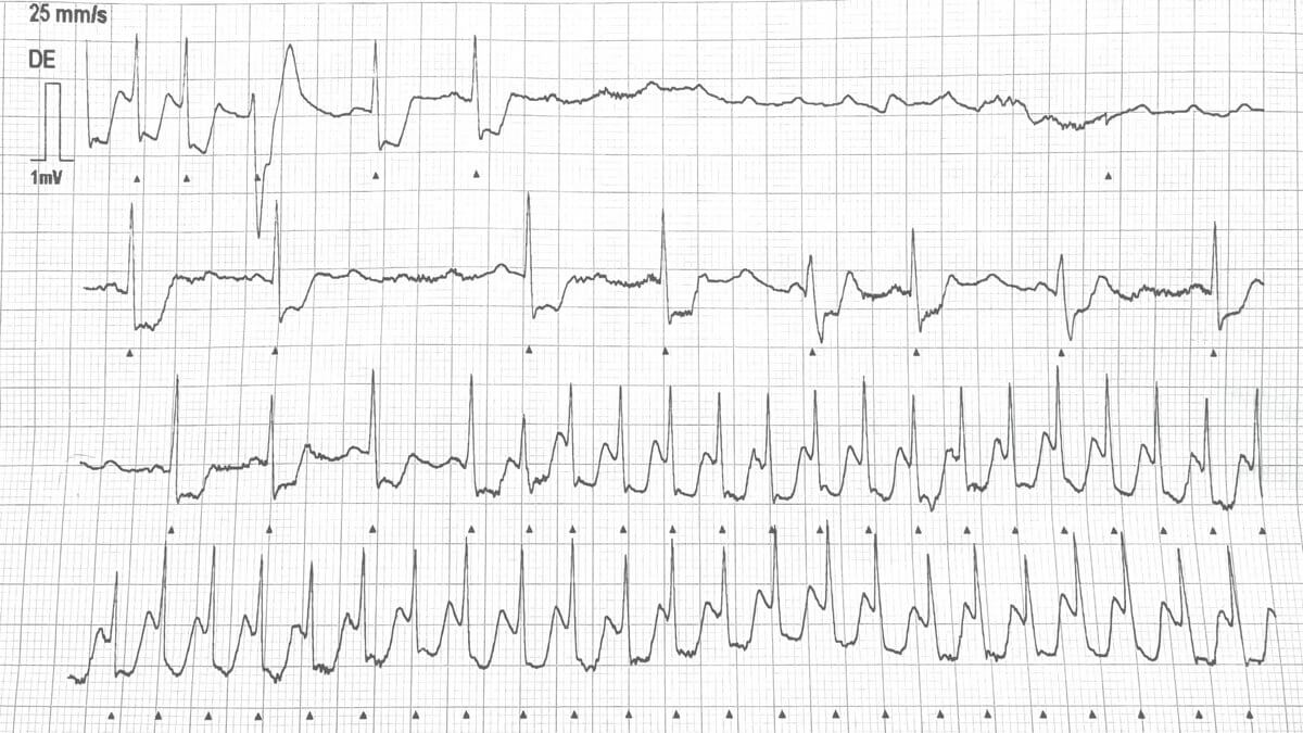 Adenosin bei Schmalkomplextachykardie