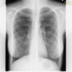 Röntgen-Thorax - DocCheck Flexikon