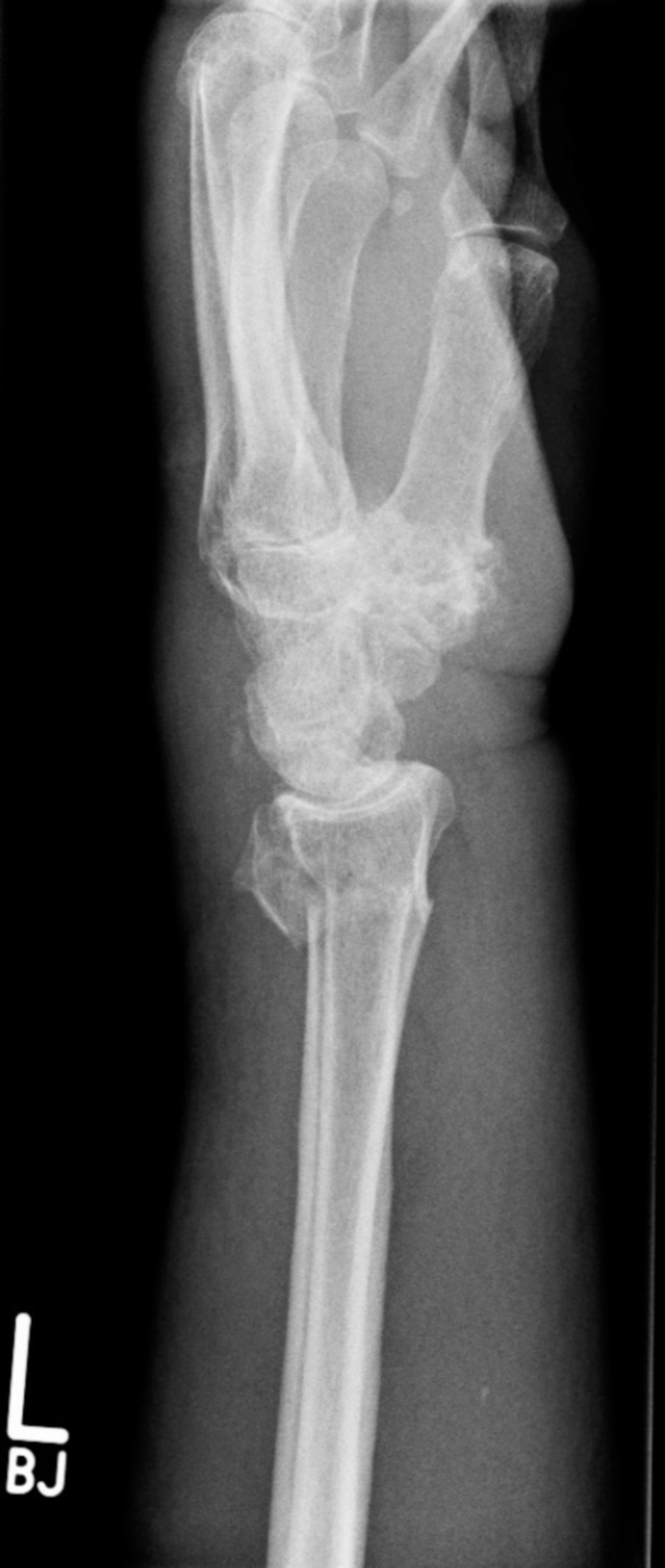Röntgen des distalen Unterarmes von lateral