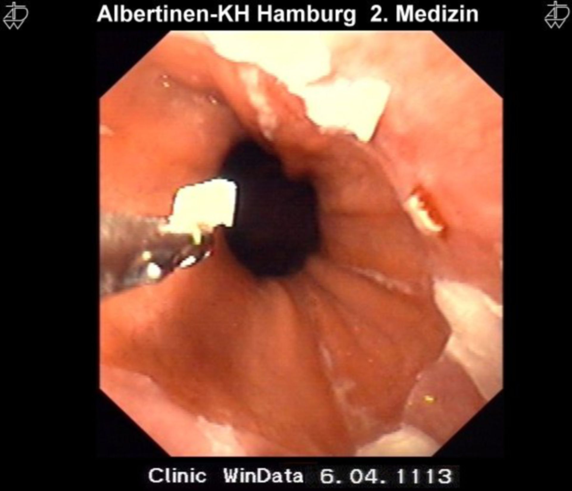 Mucosa of the esophagus