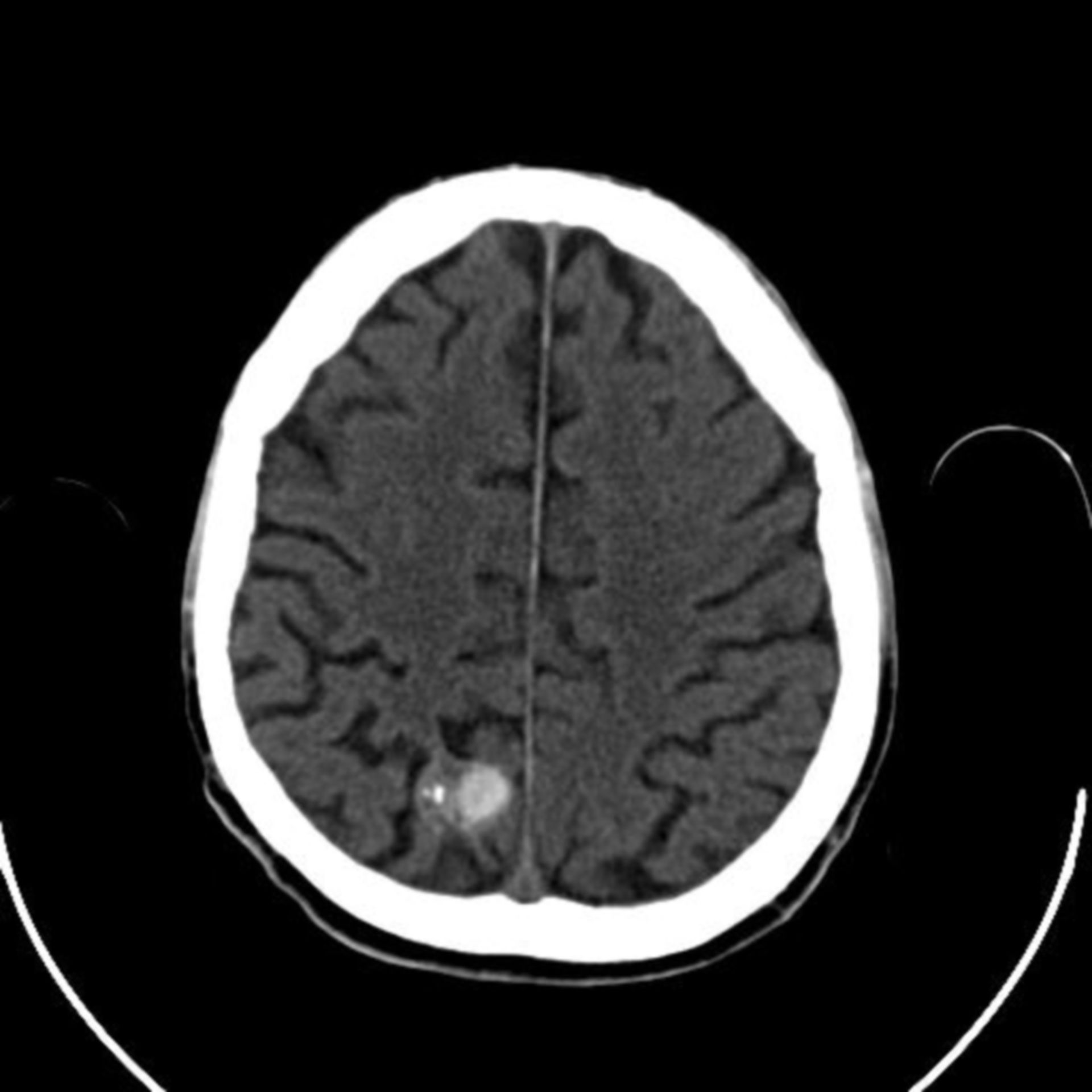 (1) Non-contrast CCT