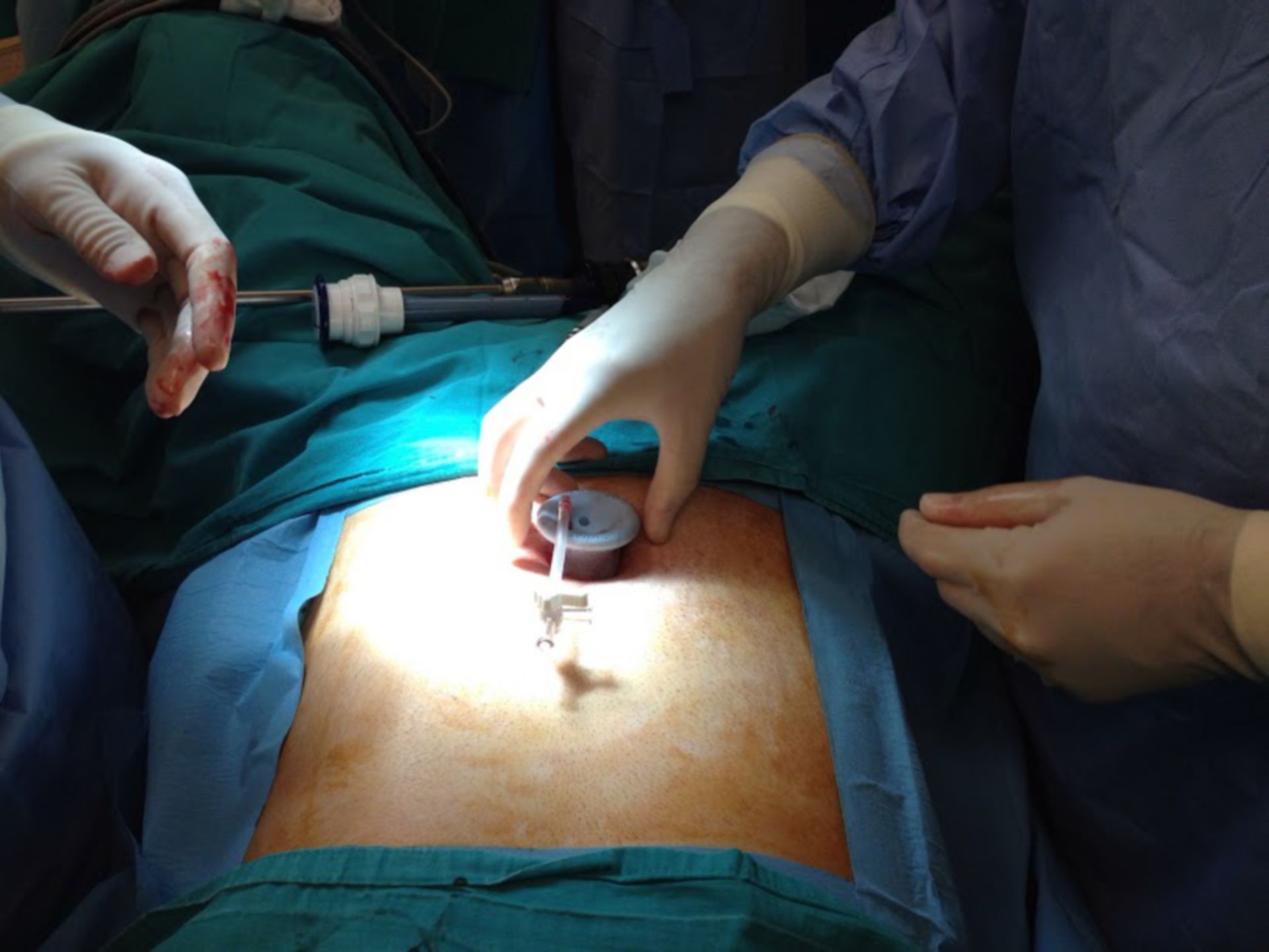 Cirugia laparoscopica por puerto unico