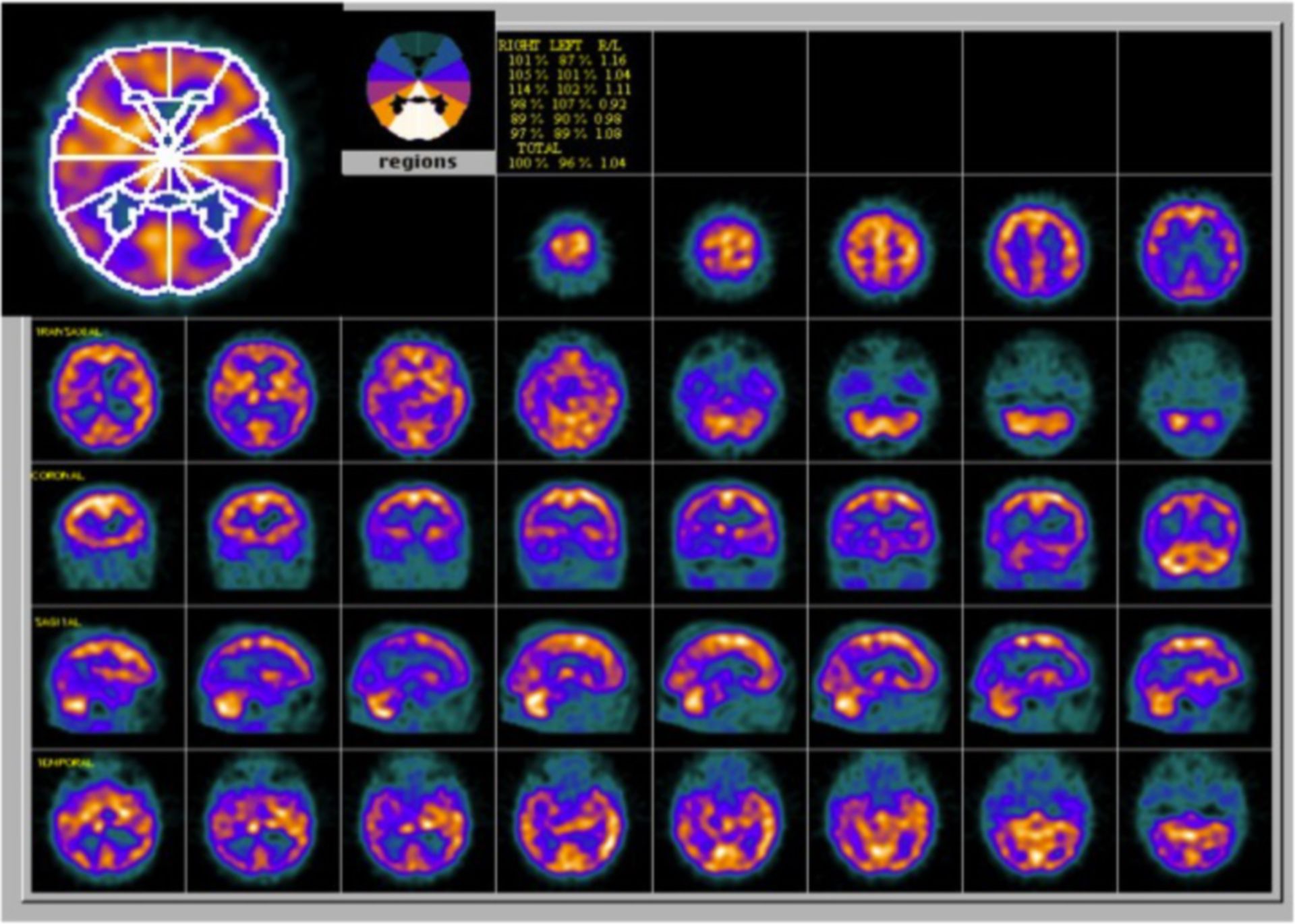 Alzheimer's disease - hypoperfusion (SPECT)