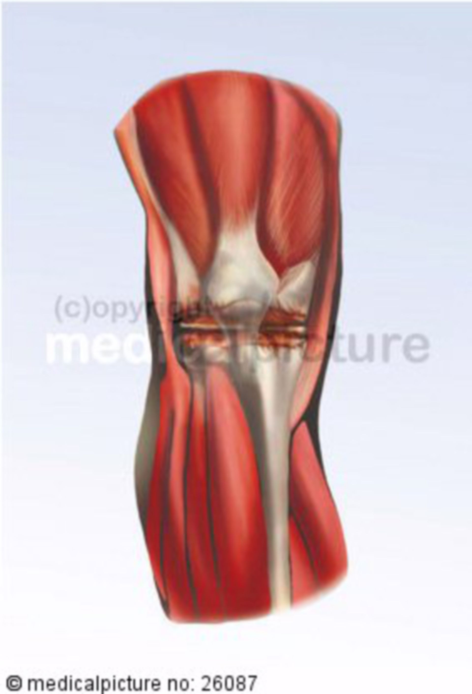  Arthritis im Kniegelenk 
