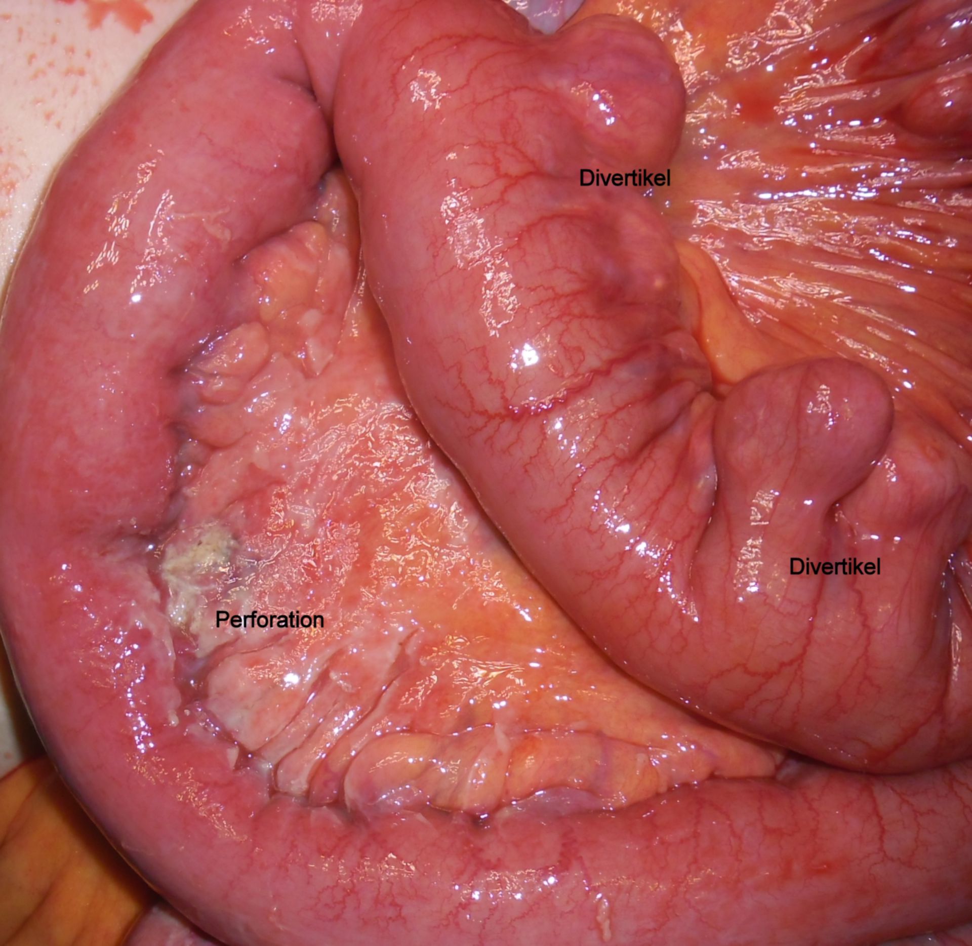 Diverticulitis del intestino delgado con perforación