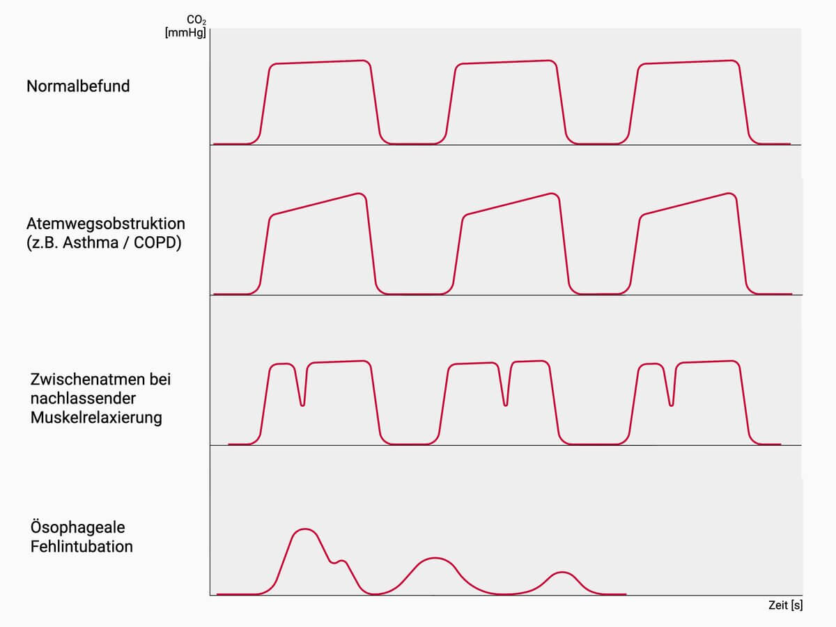 Kapnographiebefunde