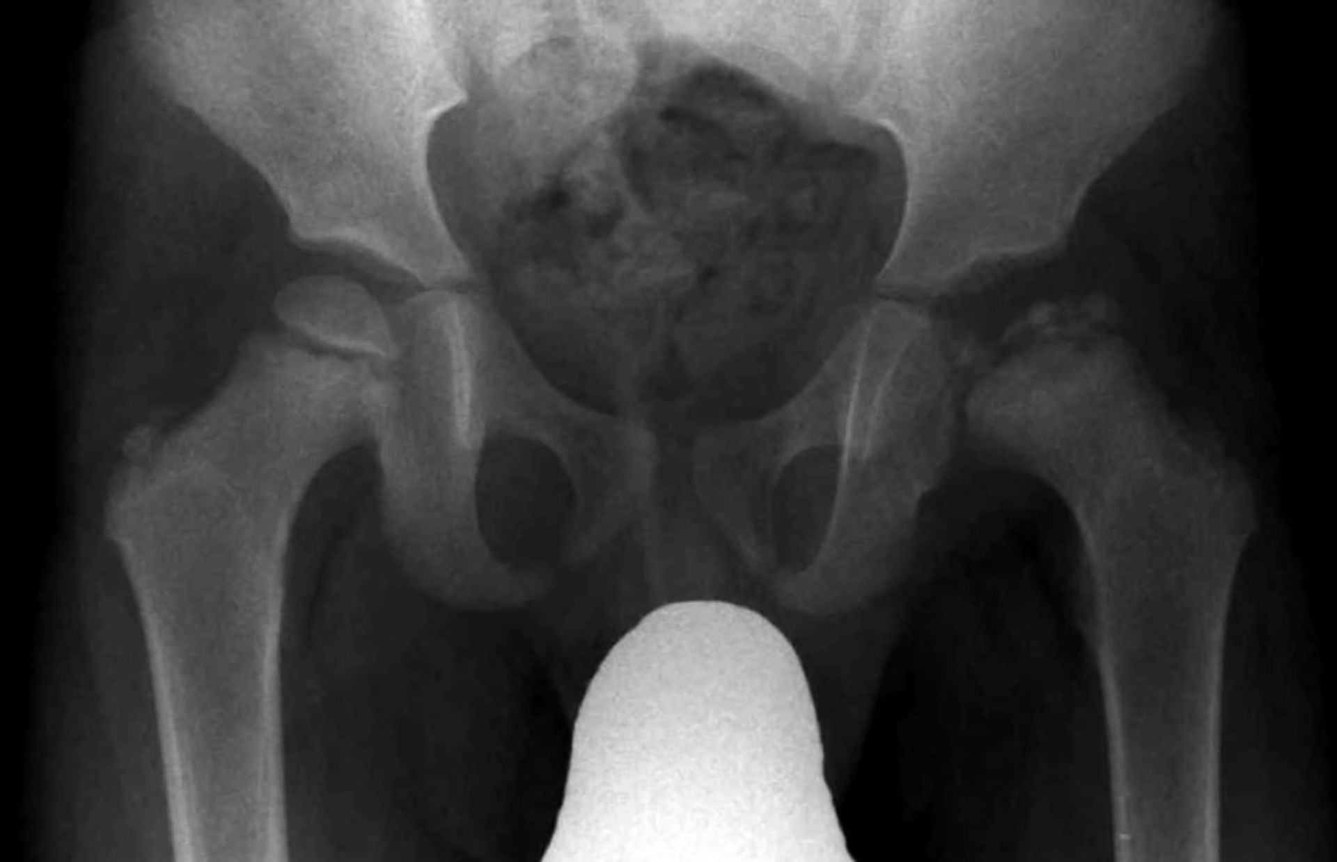 x-ray of Legg- (Calve-) Perthes Disease