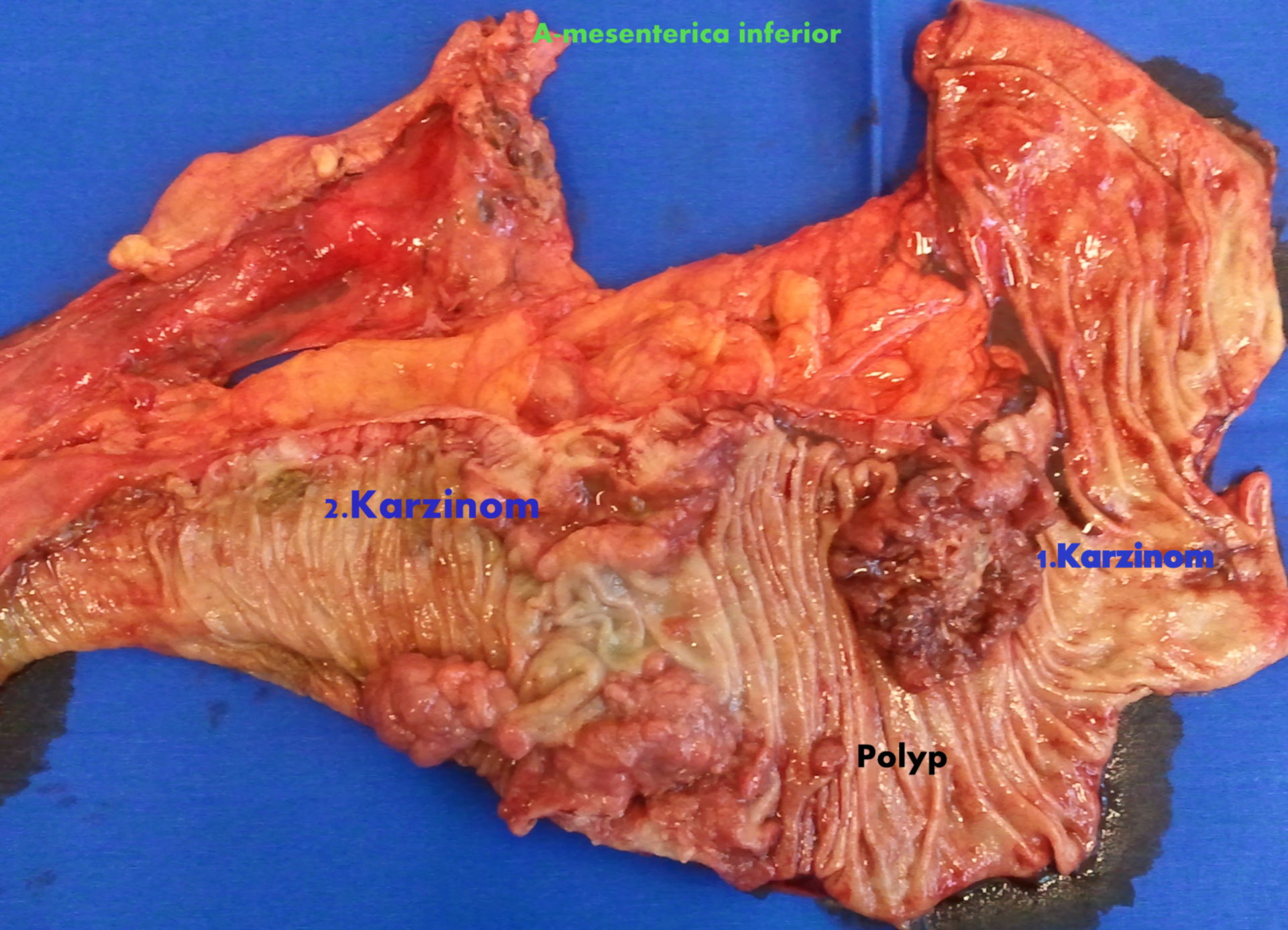 Two synchronous cancers of the sigmoid colon - specimen sliced