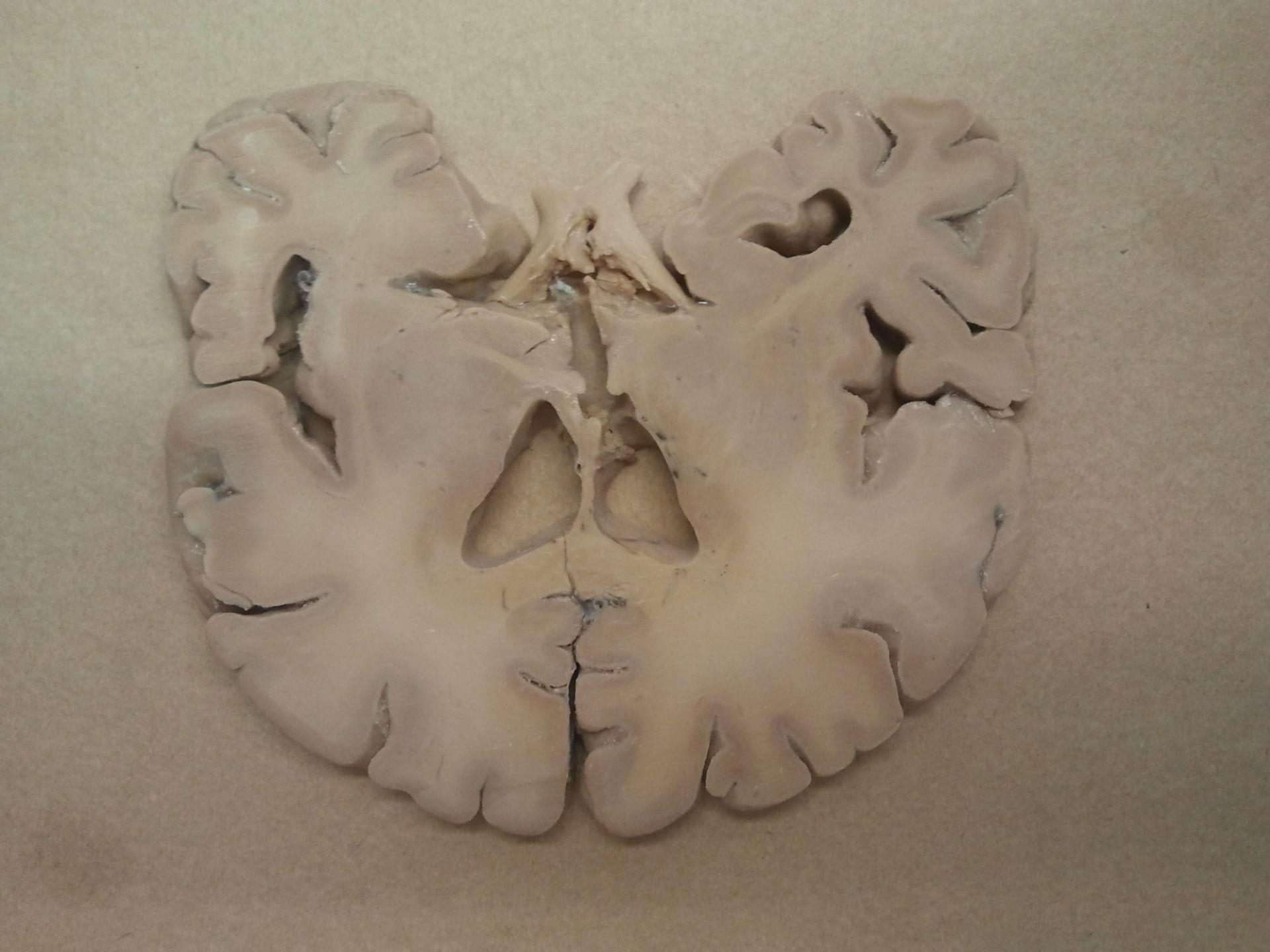 Sezione del cervello con ventricolo laterale b