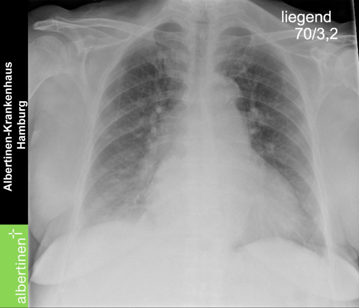 Dekompensierte Herzinsuffizienz (Röntgen-Thorax)