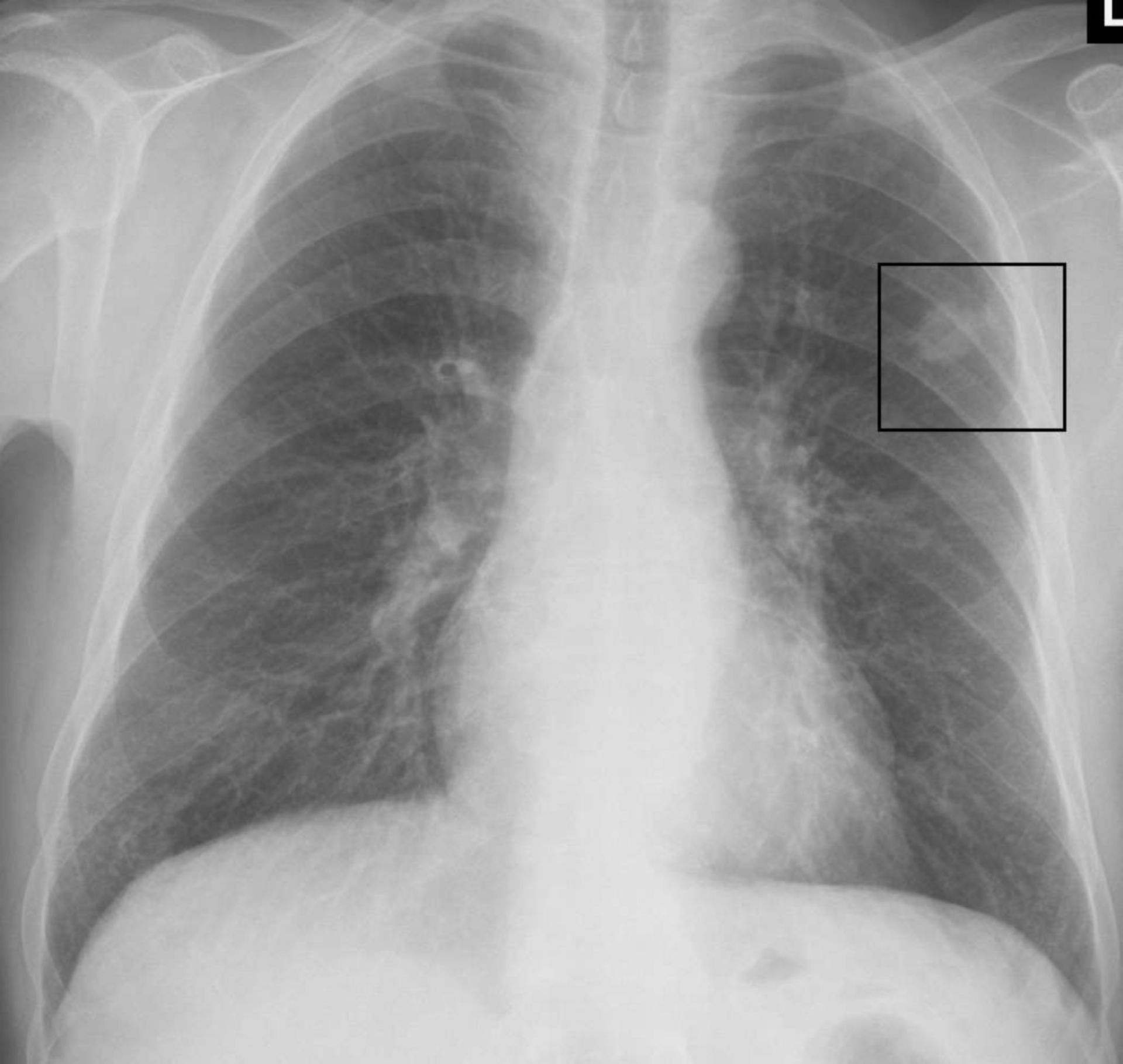 Bronchogenic carcinoma, left upper lung