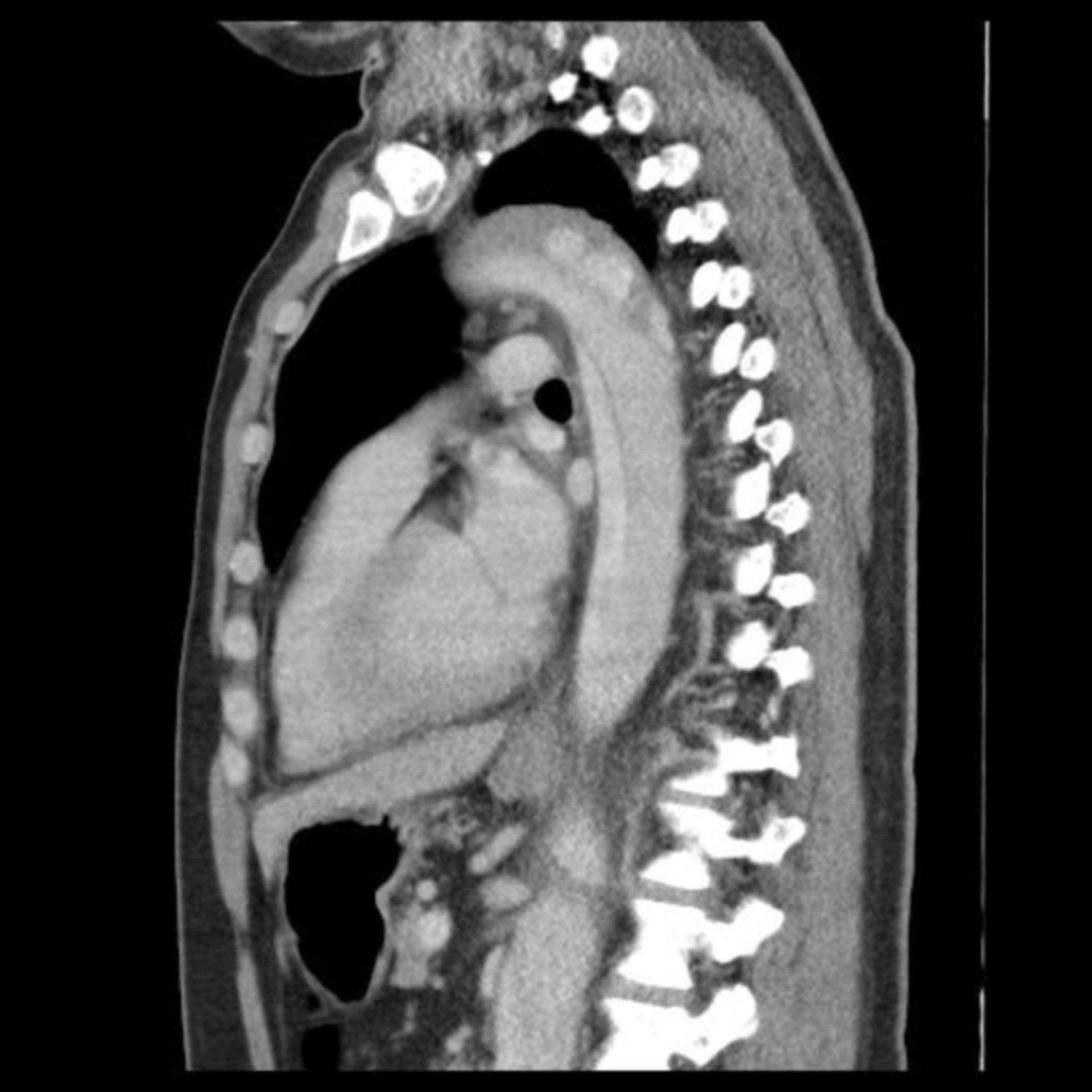 Long-ranging aortic dissection